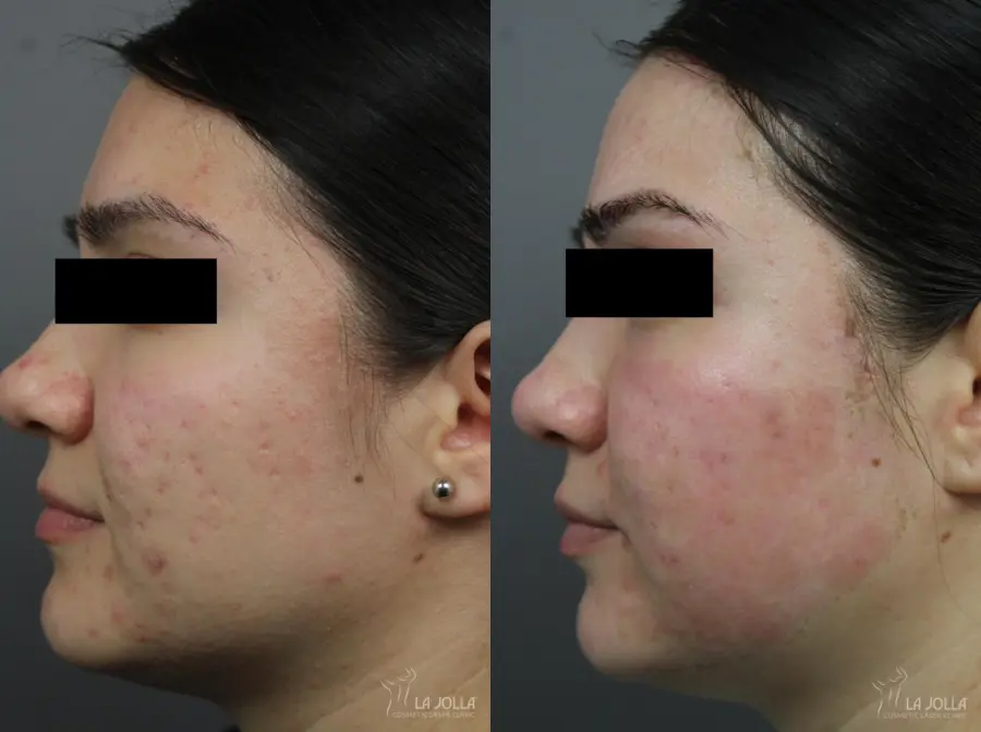 Acne Scars Before & After Gallery Patient 1