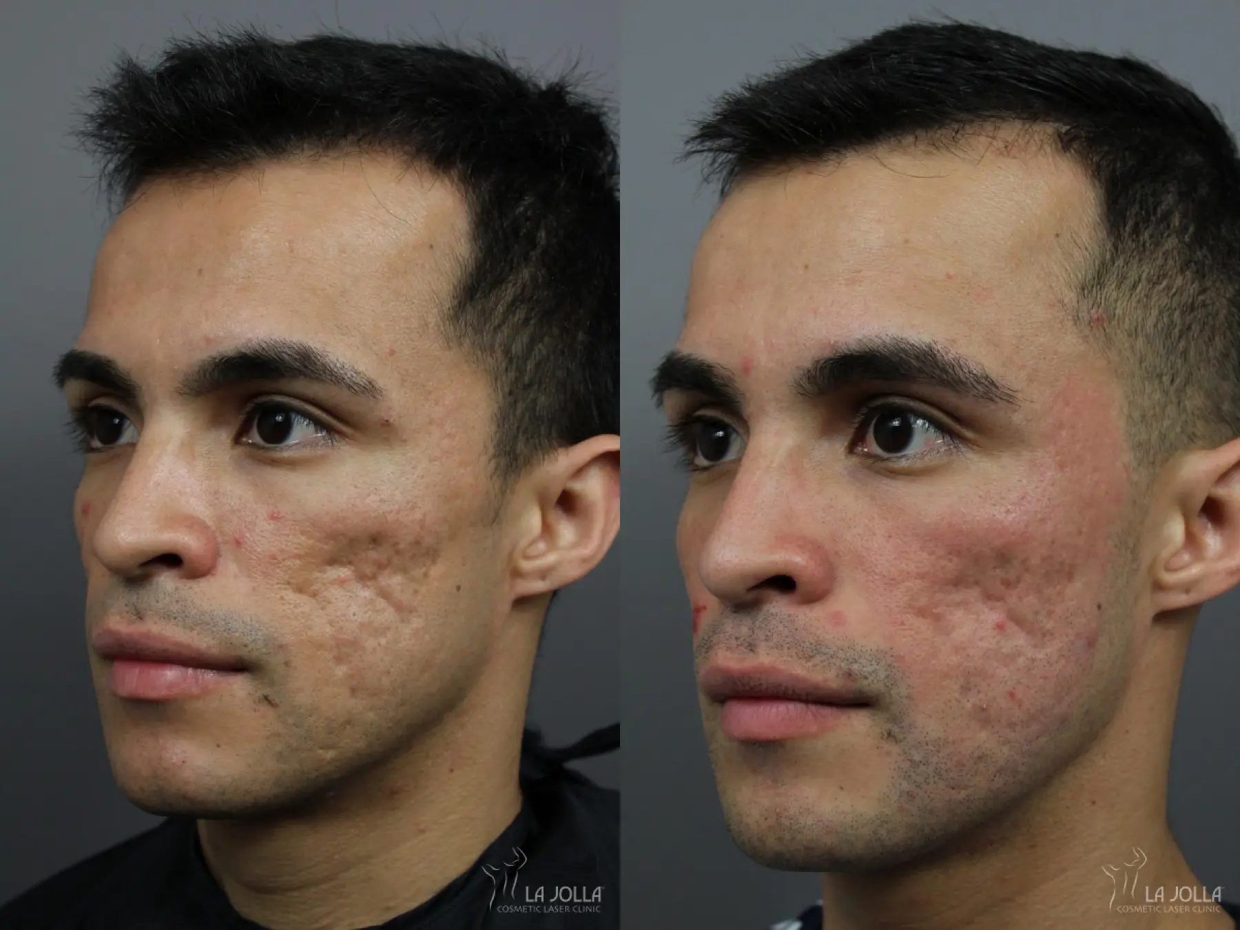 Acne Scars: Patient 8 - Before and After  