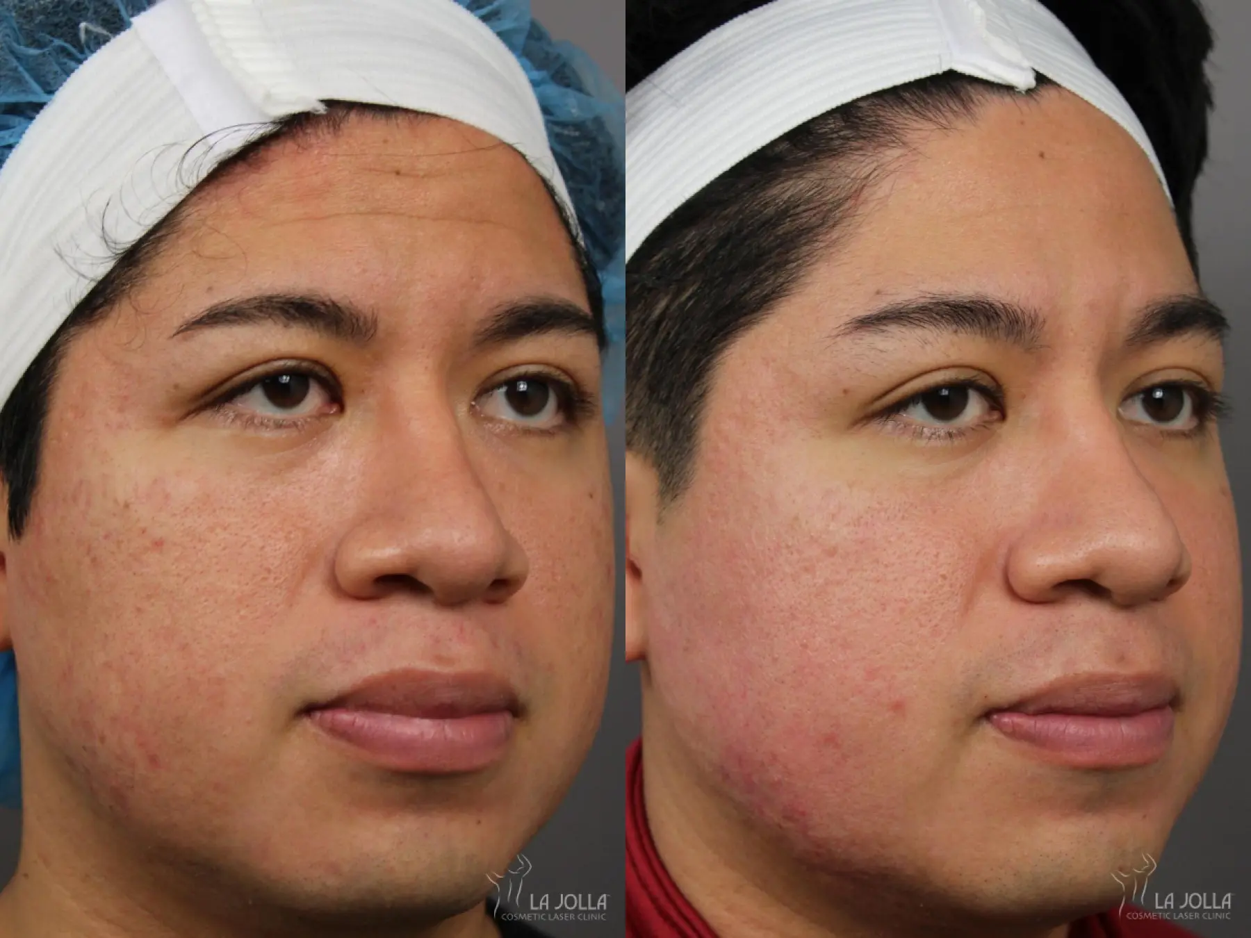 Acne Scars: Patient 9 - Before and After 3