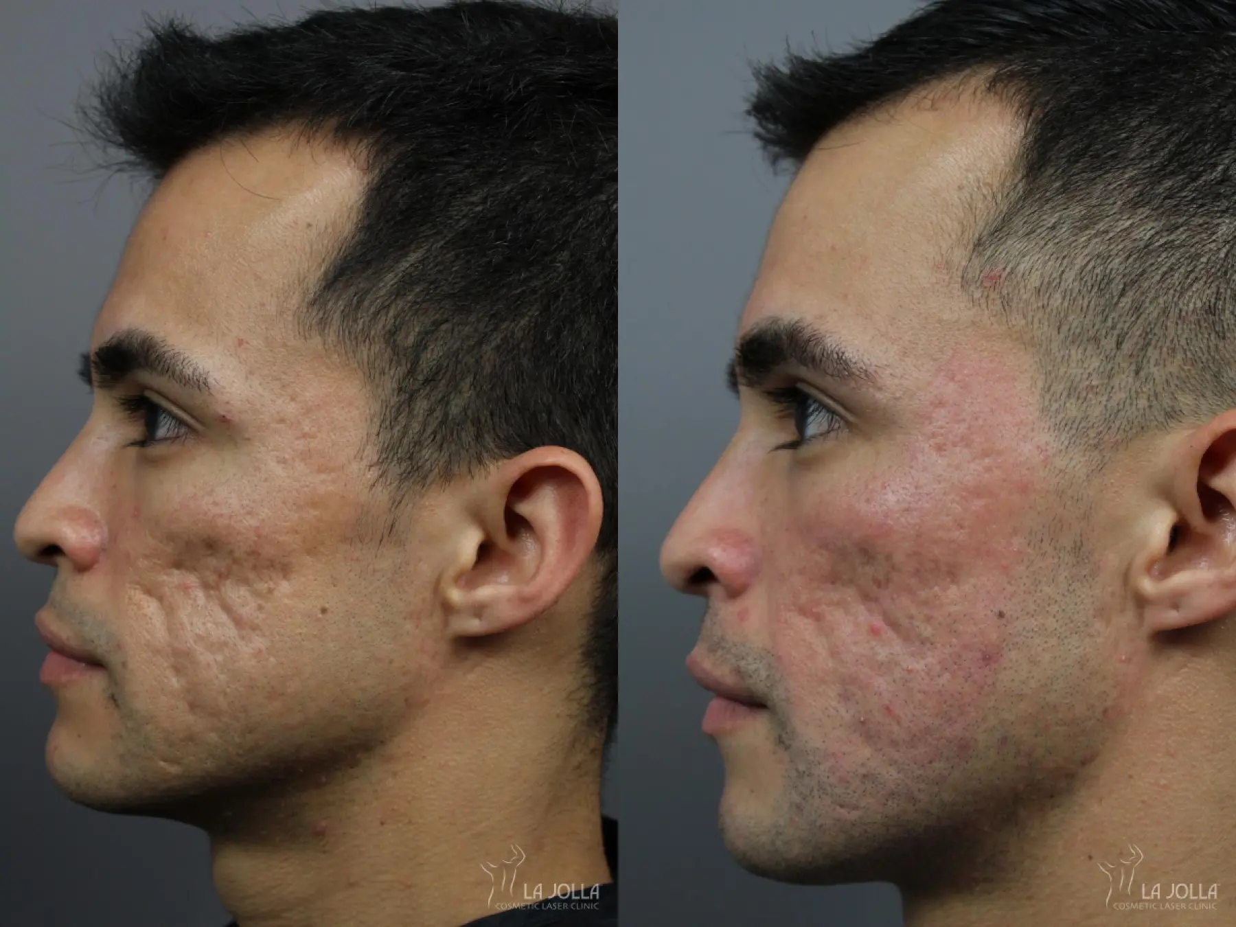 Acne Scars: Patient 8 - Before and After 4