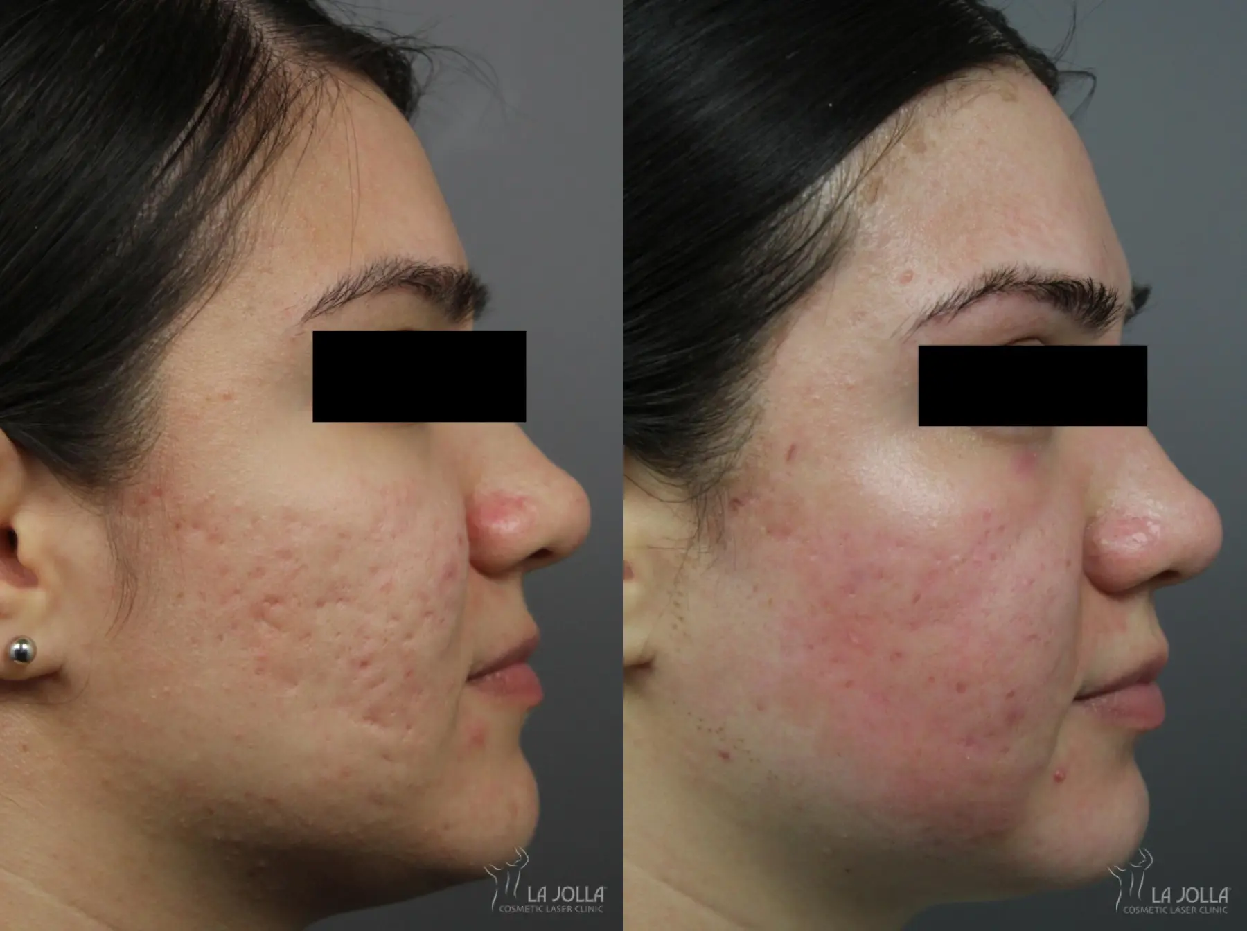 Acne Scars: Patient 1 - Before and After 1