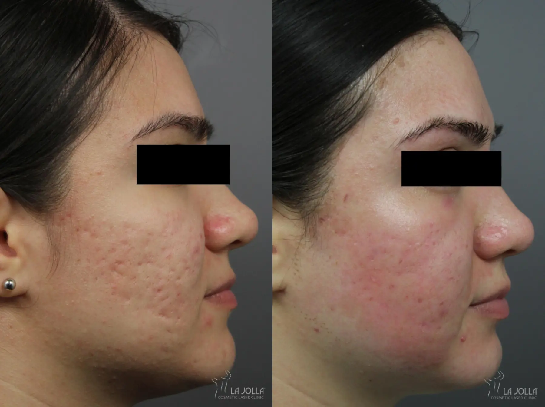 Acne Scars: Patient 1 - Before and After  