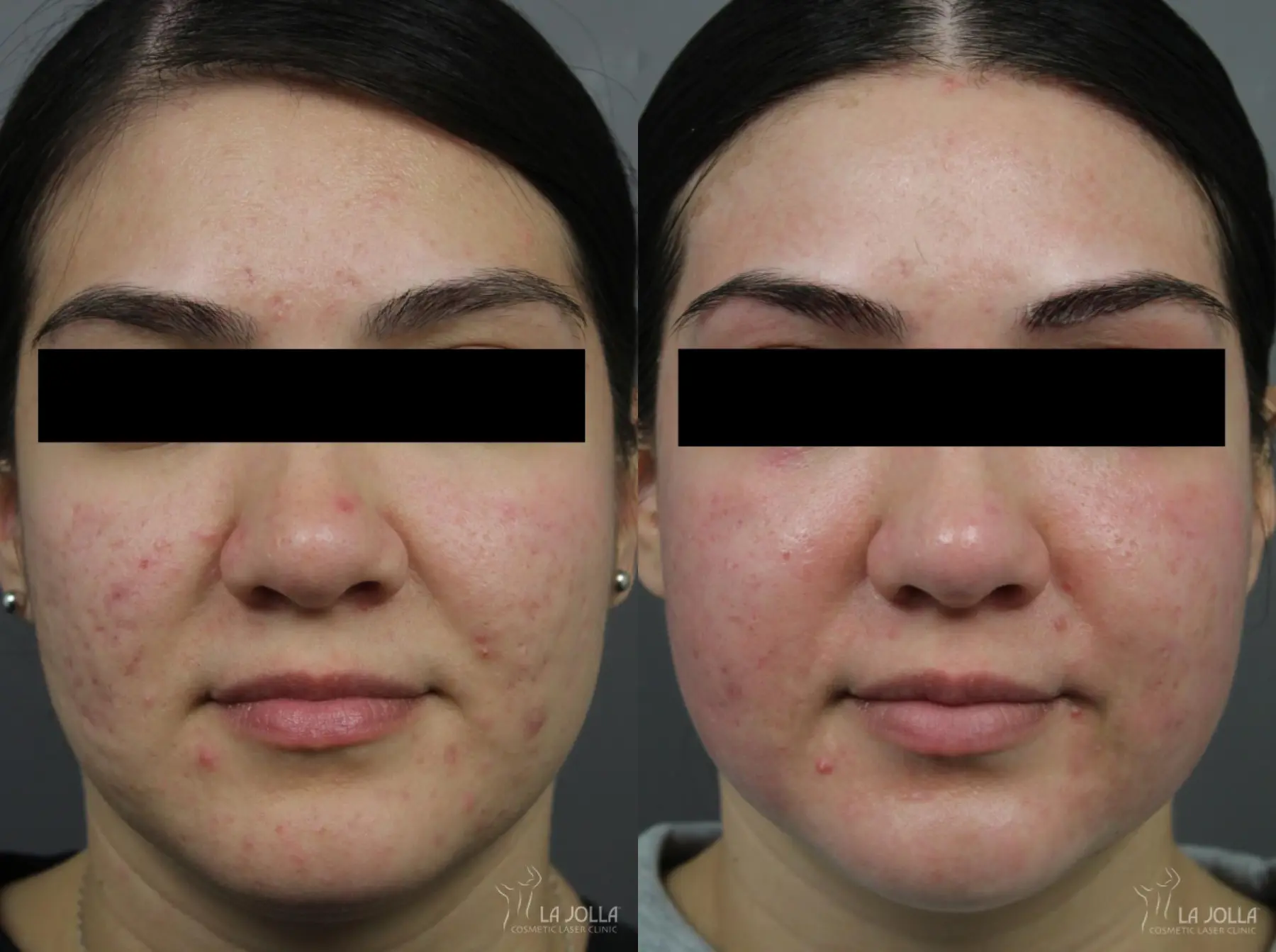 Acne Scars: Patient 22 - Before and After 2