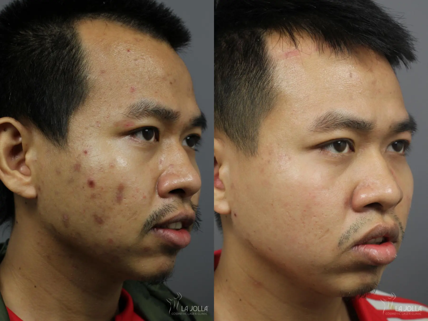 Acne Scars: Patient 5 - Before and After 2