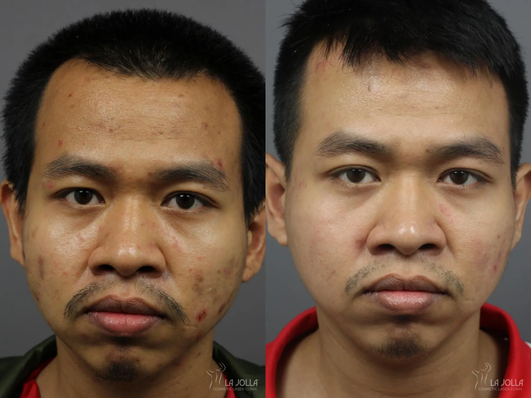 Acne Scars: Patient 5 - Before and After  