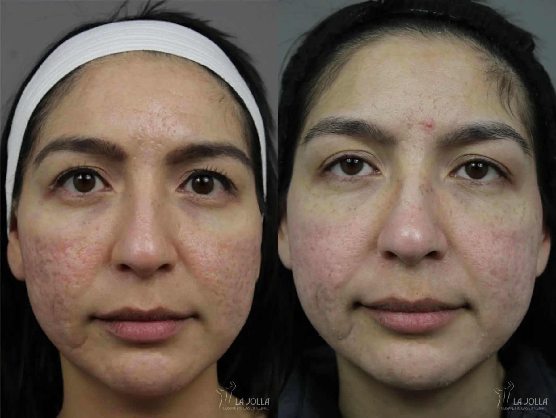Acne Scars: Patient 2 - Before and After  