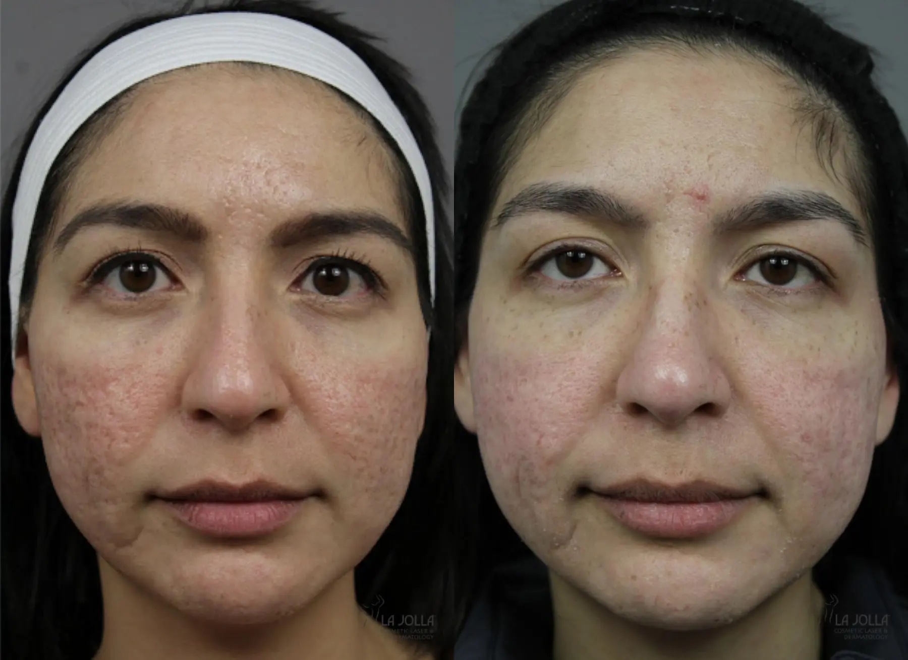 Fraxel Acne Scars Before And After Laser Treatment Acne Scars NYC Fraxel Acne Scars Before And After Laser Treatment Acne Scars NYC