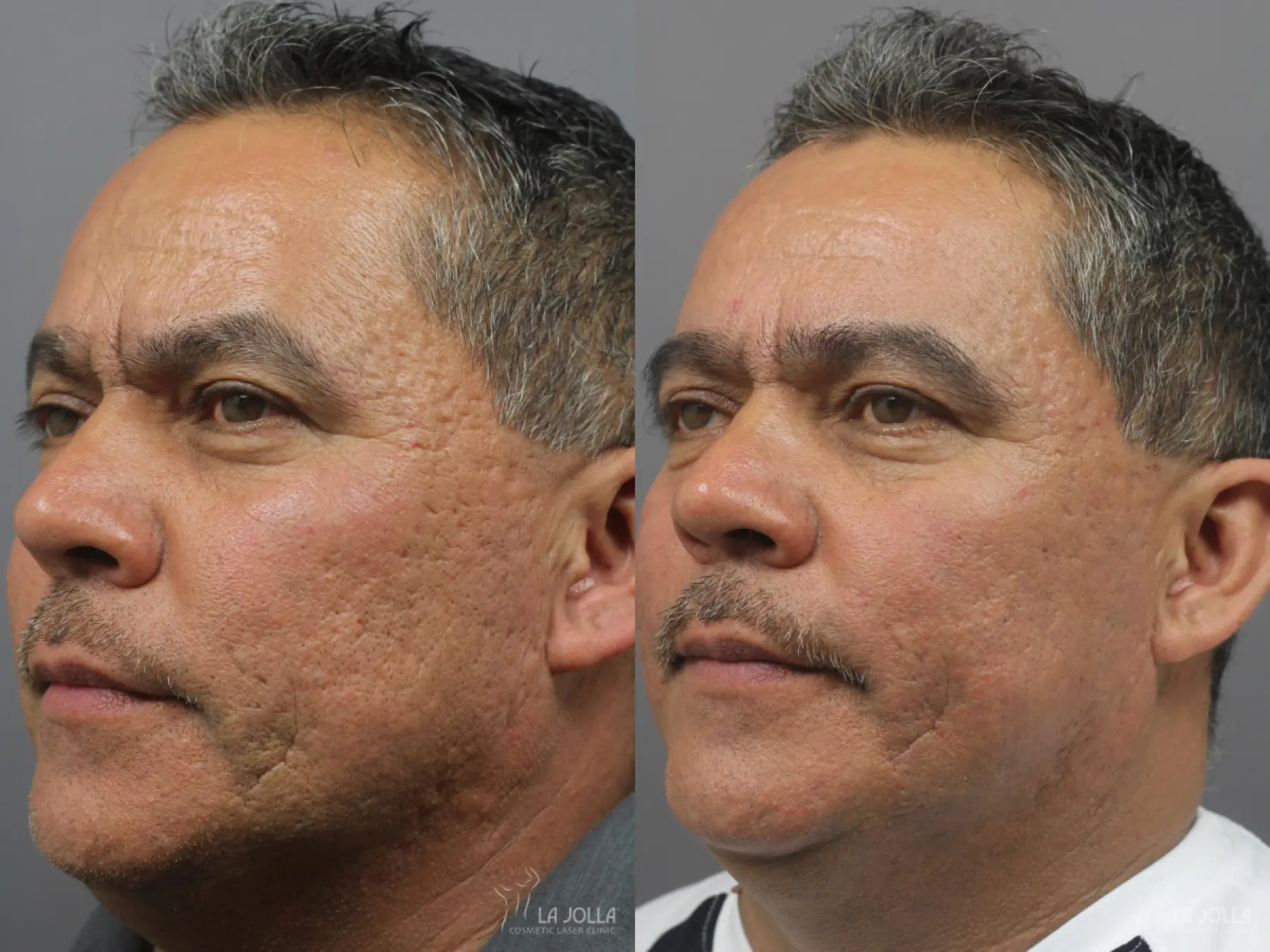 Acne Scars: Patient 12 - Before and After 1