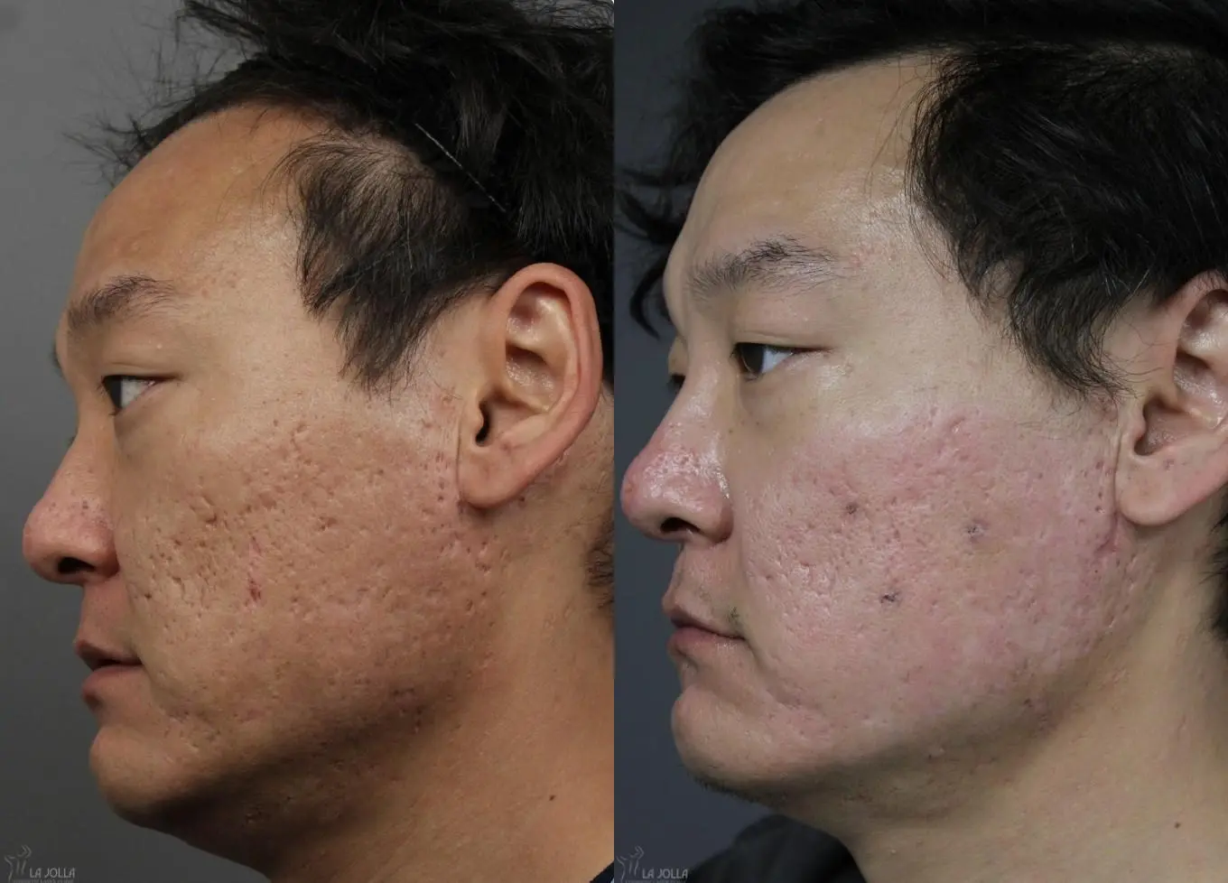 Acne Scars: Patient 1 - Before and After 3
