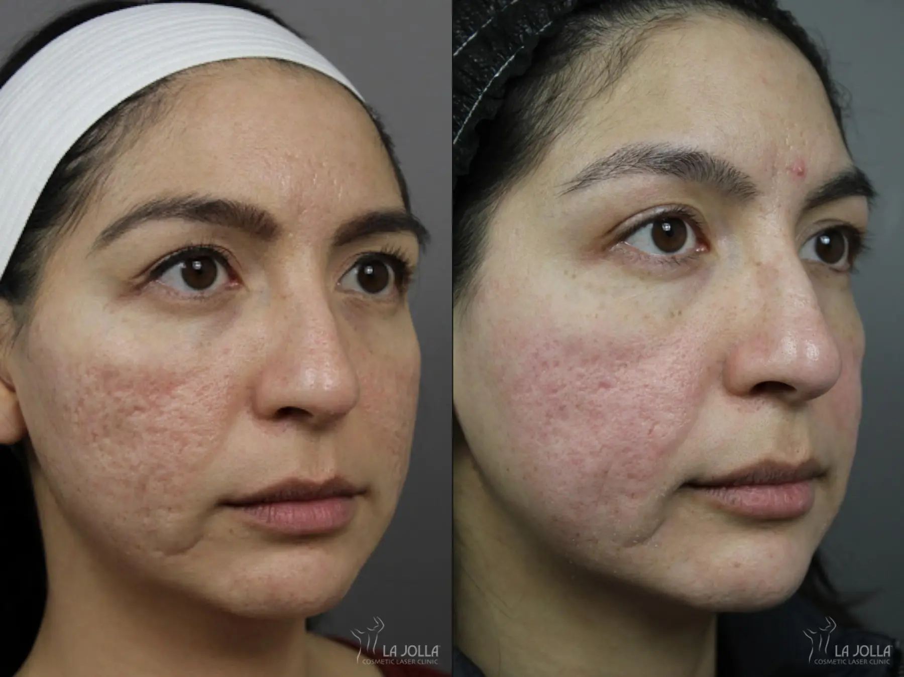 Acne Scars: Patient 2 - Before and After 2