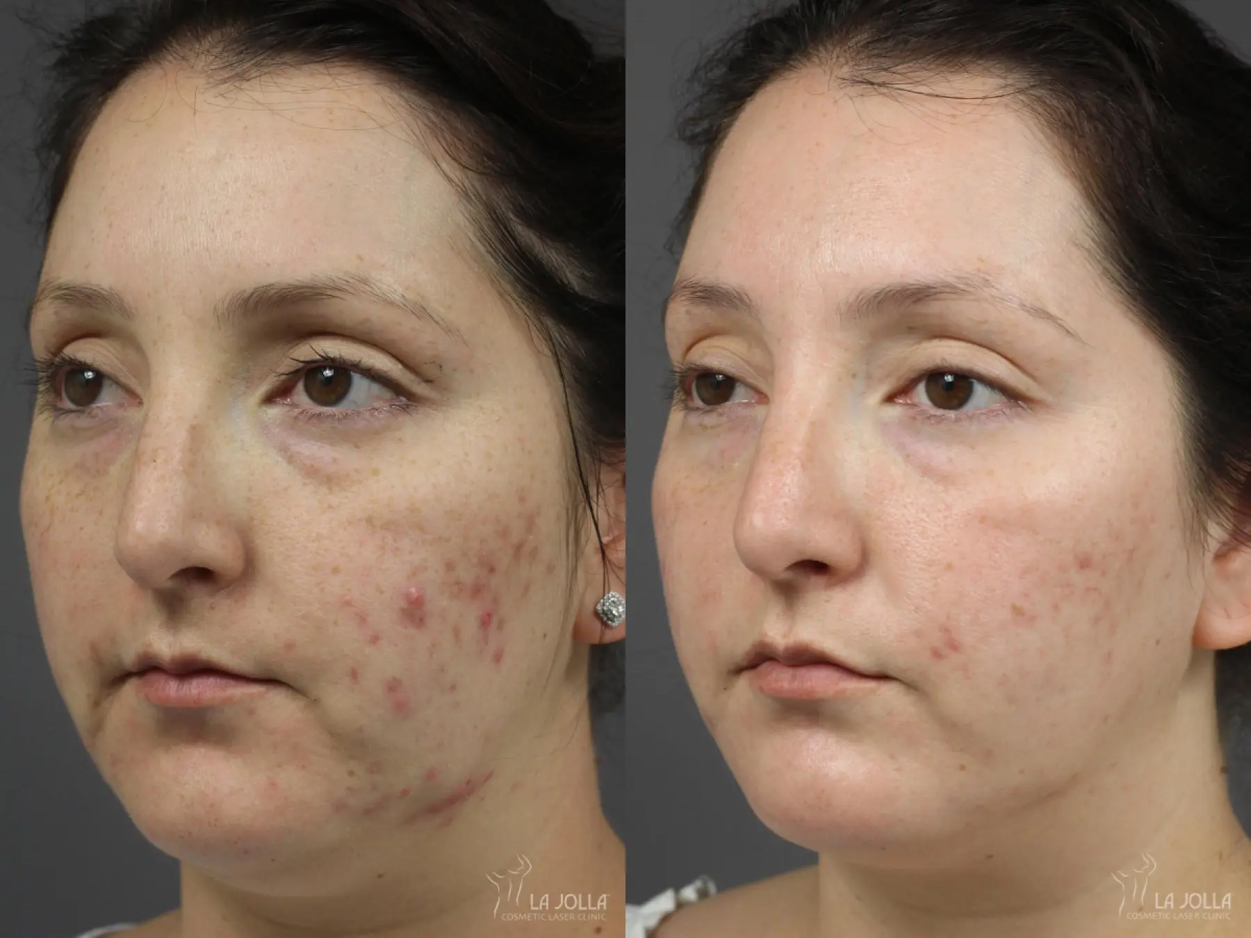 Acne Scars: Patient 10 - Before and After 1