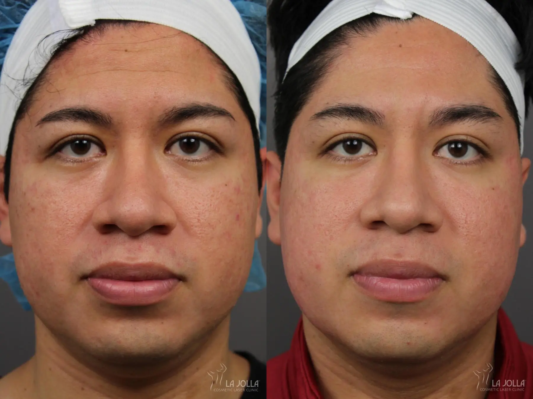 Acne Scars: Patient 18 - Before and After 2