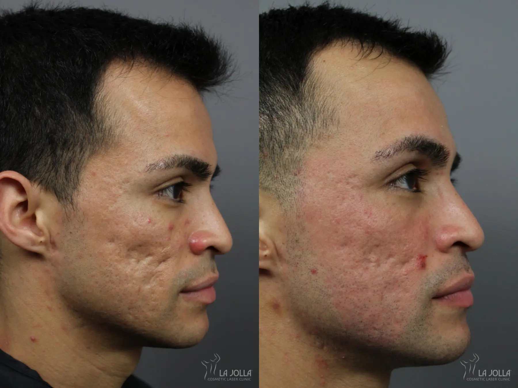 Acne Scars: Patient 8 - Before and After 3