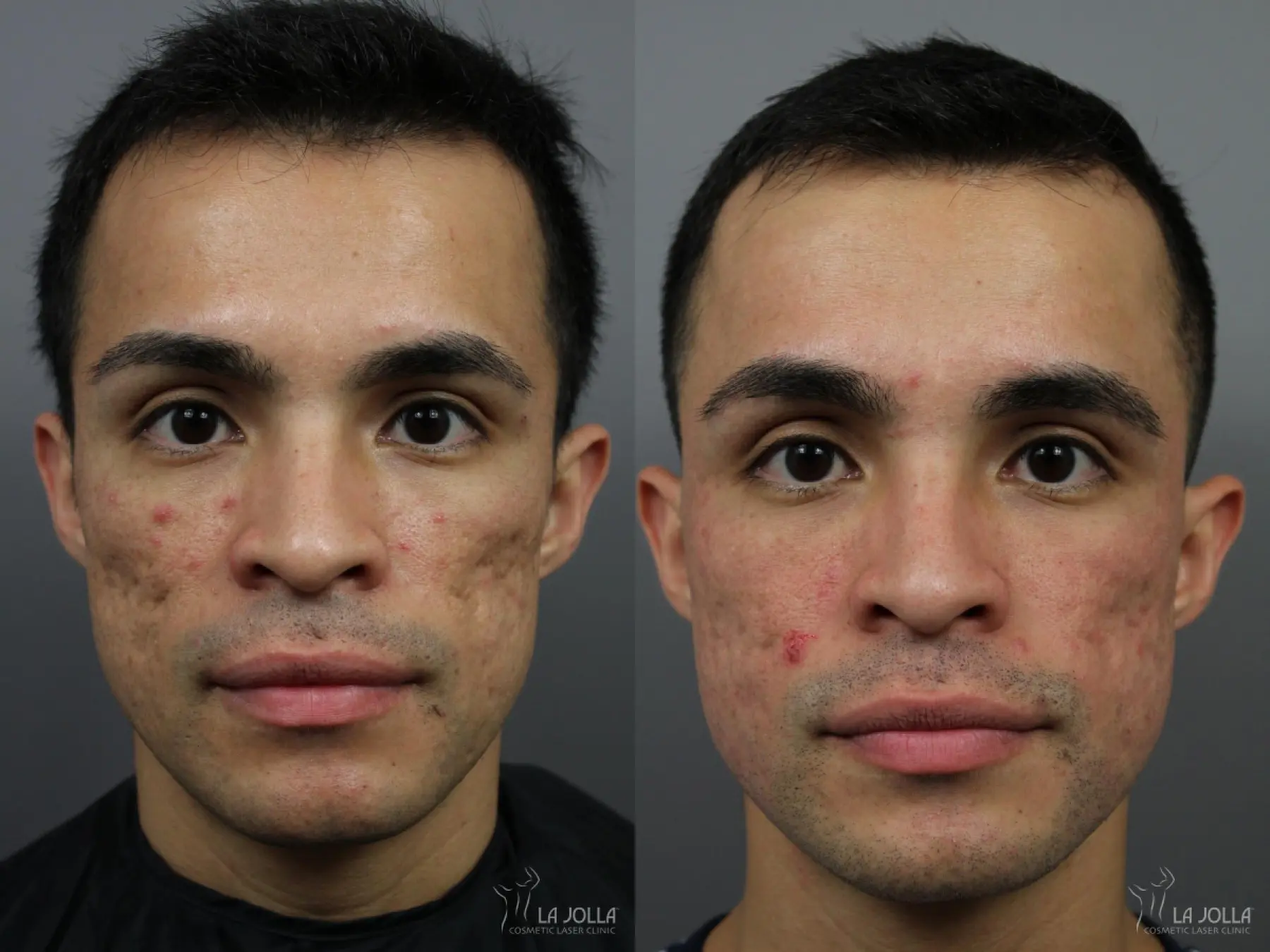 Acne Scars: Patient 8 - Before and After 2