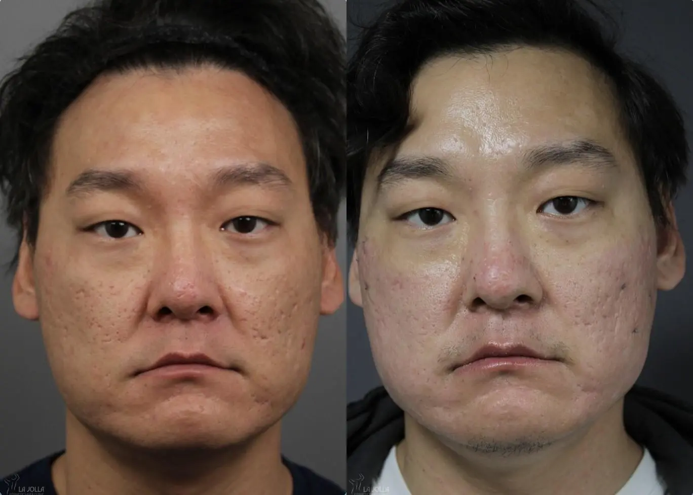 Acne Scars: Patient 1 - Before and After 1