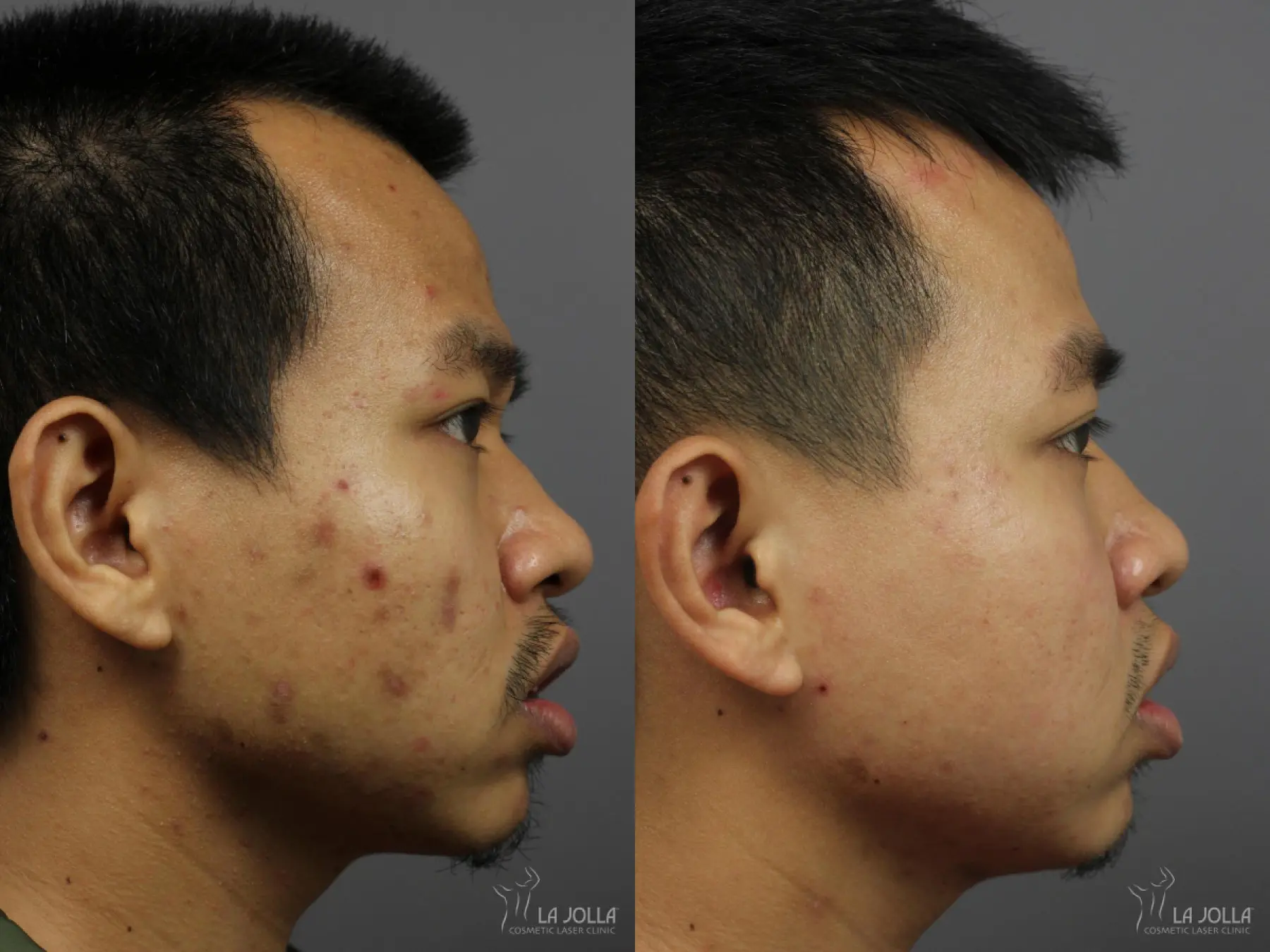 Acne Scars: Patient 5 - Before and After 3