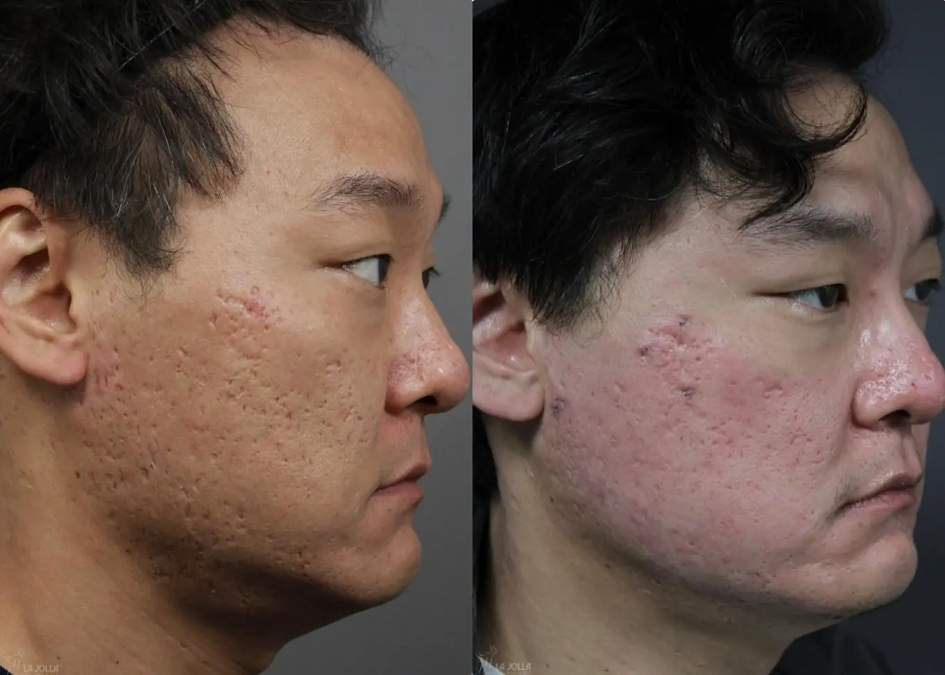 Acne Scars: Patient 1 - Before and After 2