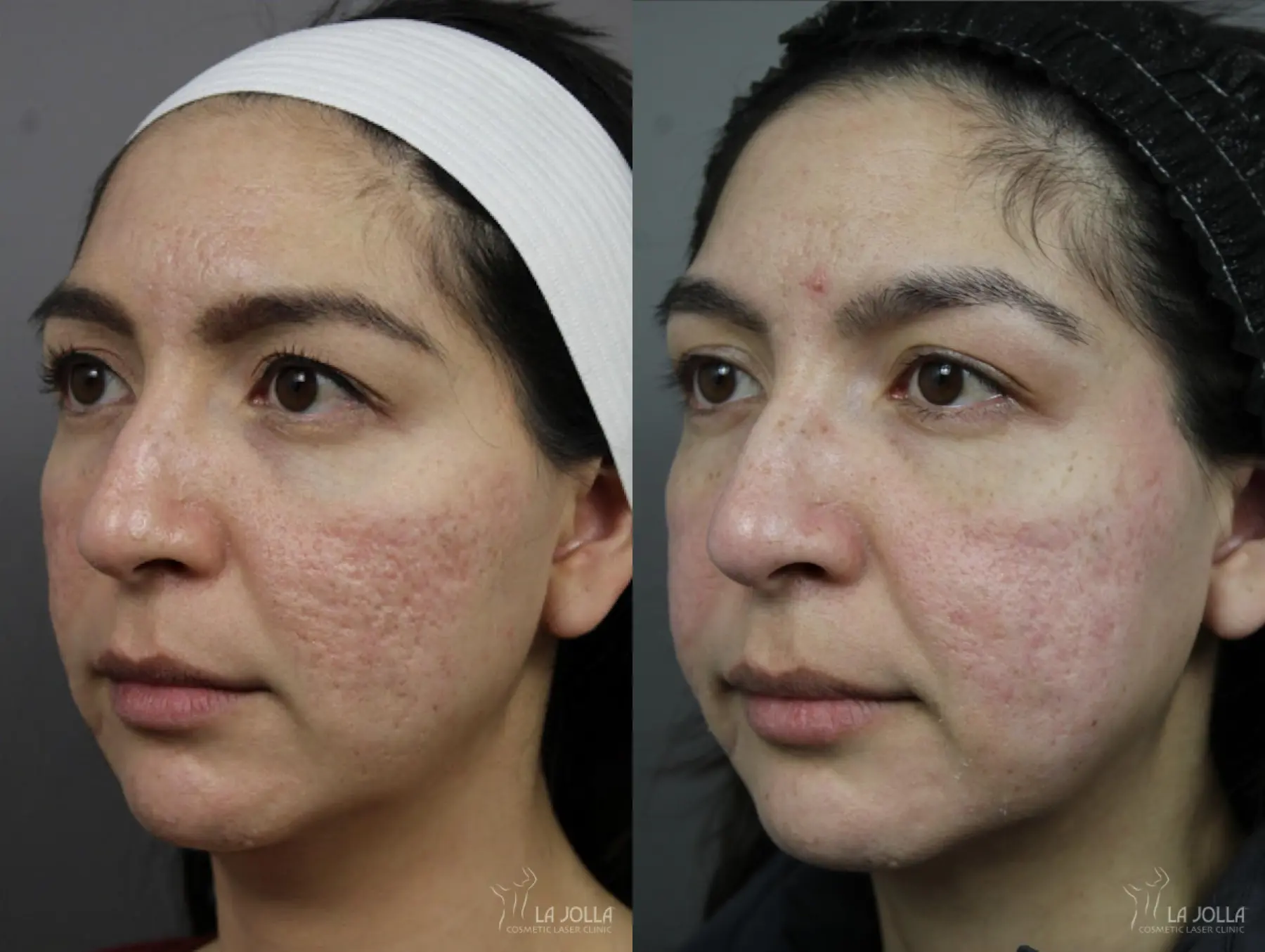 Acne Scars: Patient 2 - Before and After 3