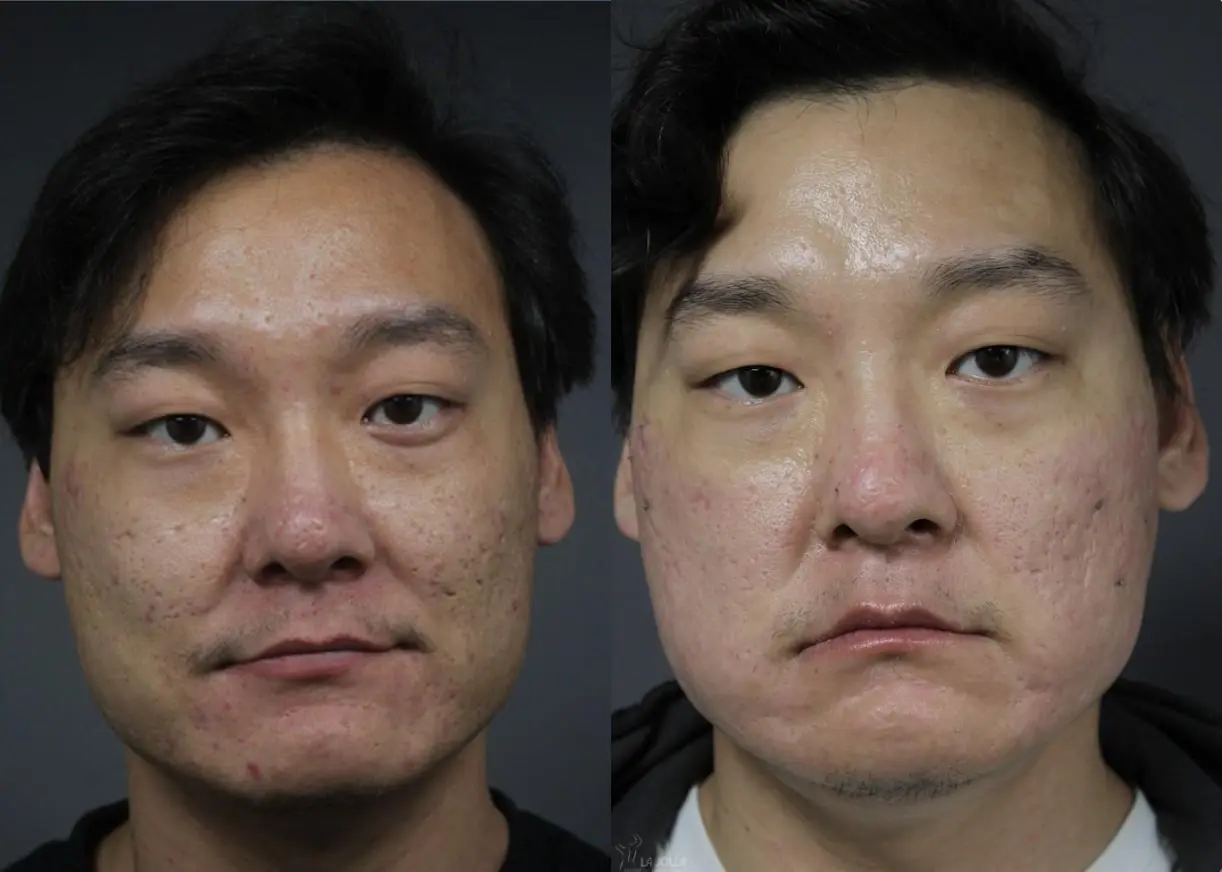 Acne Scars: Subcision : Patient 3 - Before and After  
