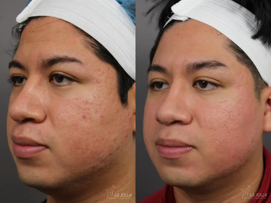 Acne Scars: Patient 9 - Before and After  