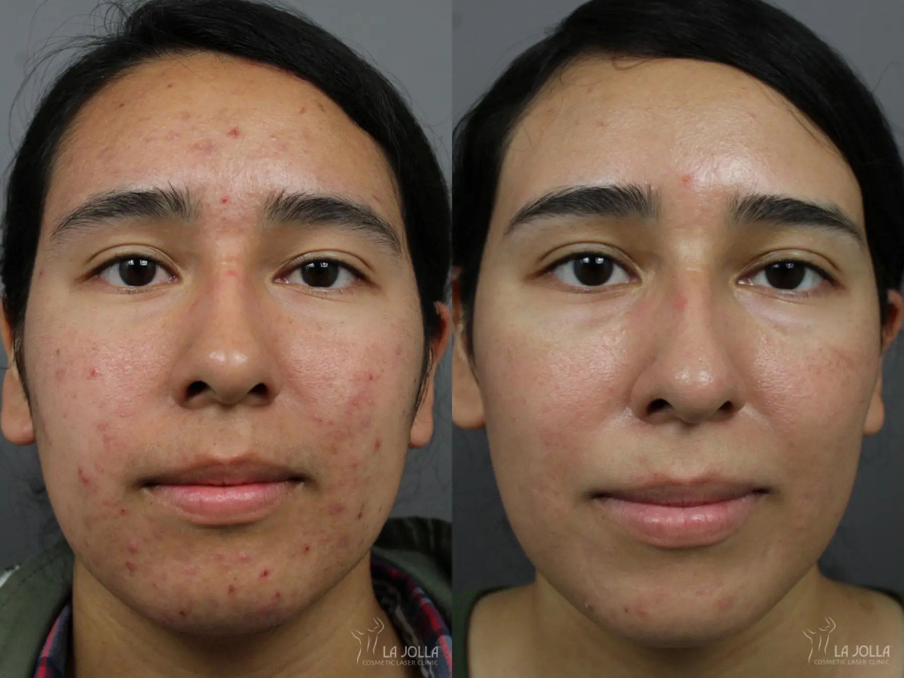 Acne: Laser Treatment: Patient 9 - Before and After  