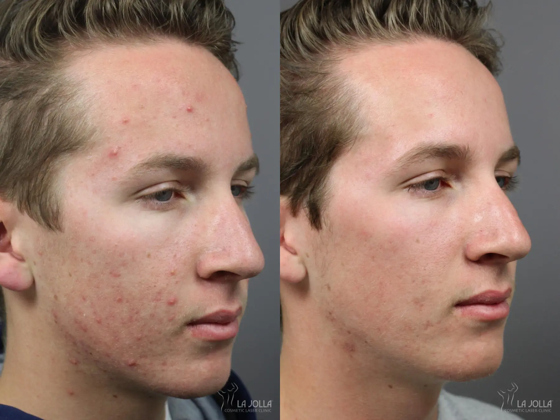 Acne: Laser Treatment: Patient 2 - Before and After 3