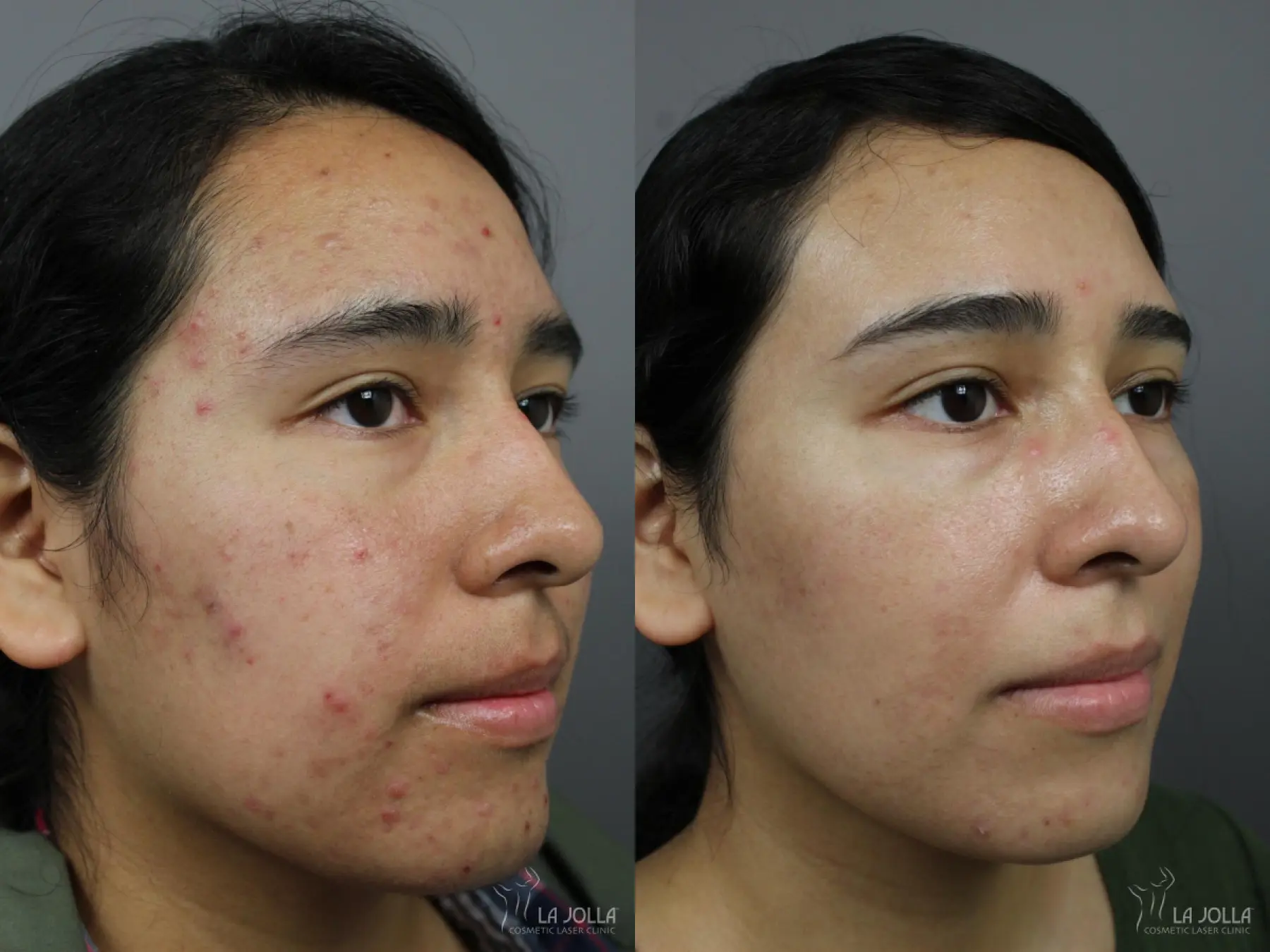 Acne: Laser Treatment: Patient 9 - Before and After 3