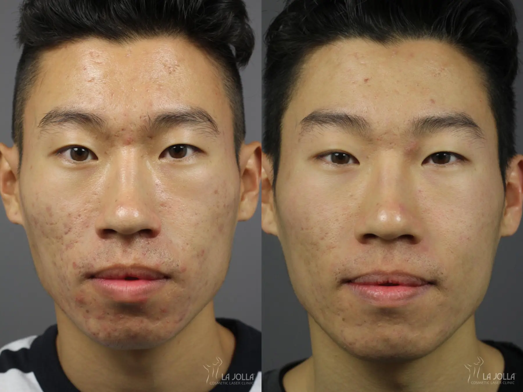 Acne: Laser Treatment: Patient 4 - Before and After  
