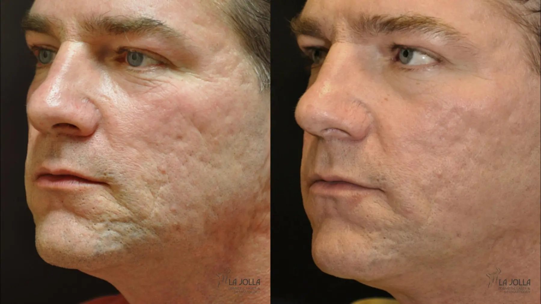 Acne: Laser Treatment: Patient 16 - Before and After 2