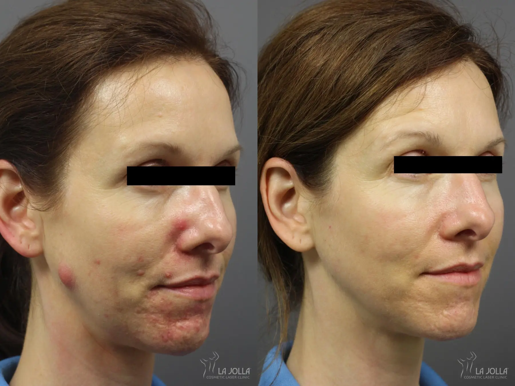 Acne: Laser Treatment: Patient 15 - Before and After 2