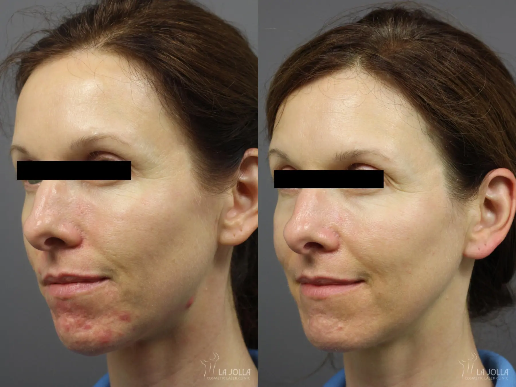 Acne: Laser Treatment: Patient 15 - Before and After 3