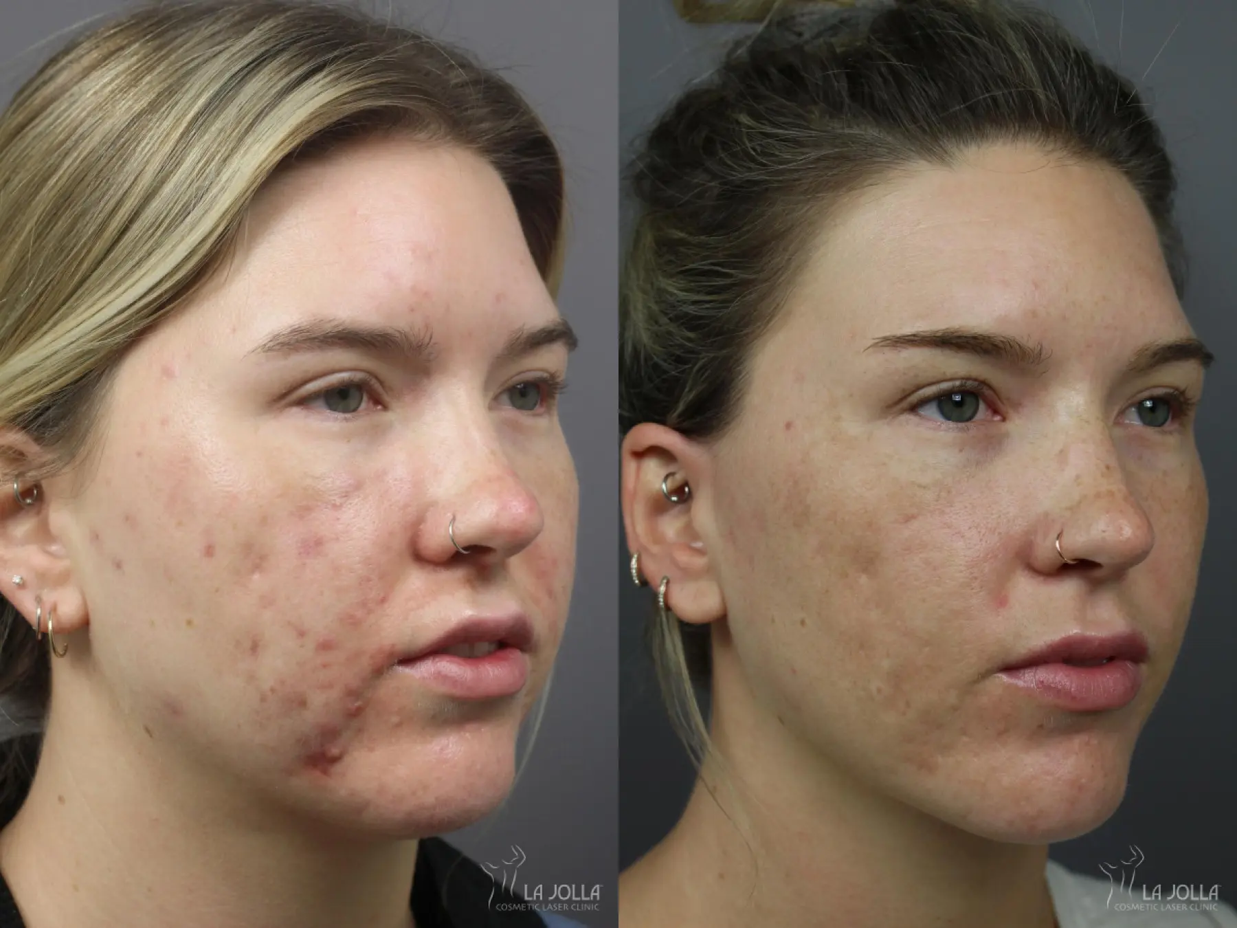Acne: Laser Treatment: Patient 1 - Before and After  
