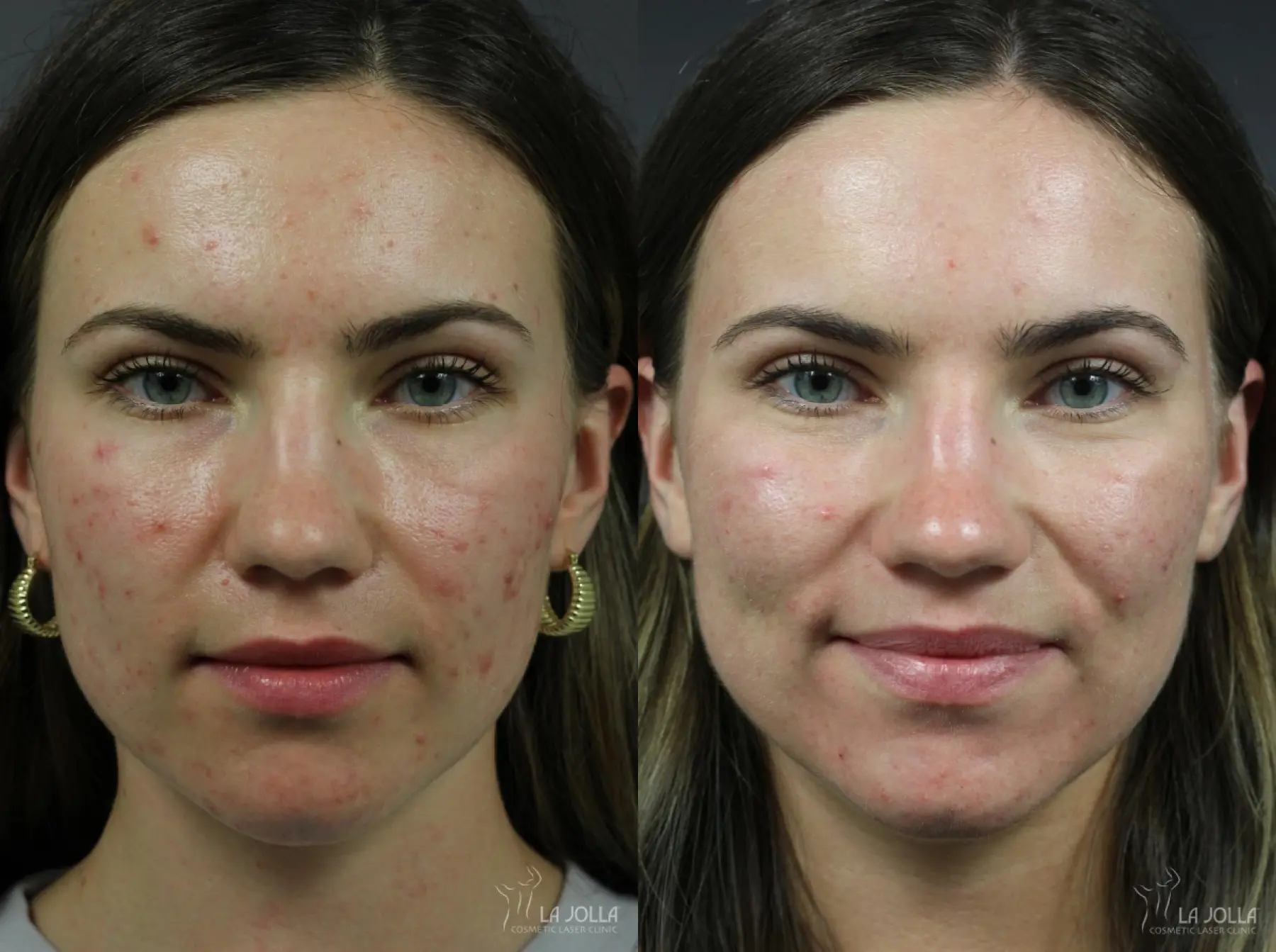 Acne: Laser Treatment: Patient 6 - Before and After  