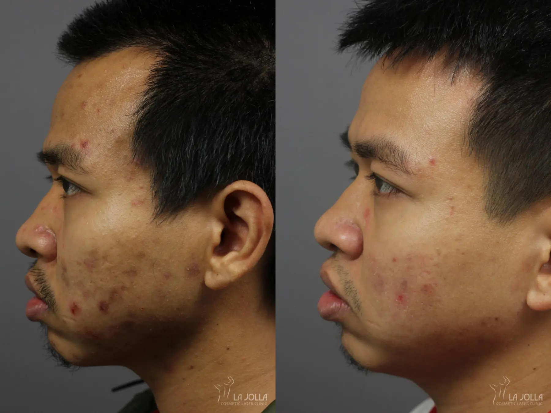 Acne: Laser Treatment: Patient 3 - Before and After 5