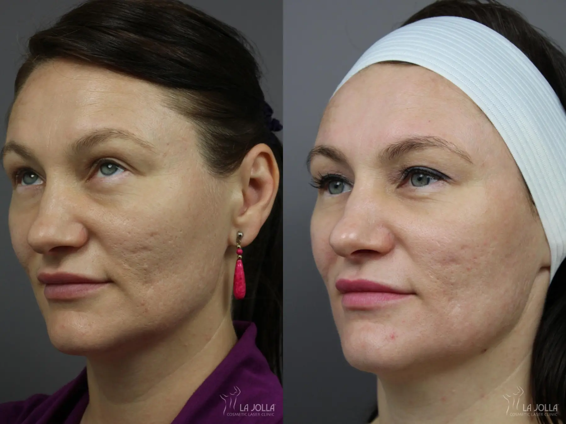 Acne: Laser Treatment: Patient 11 - Before and After 1
