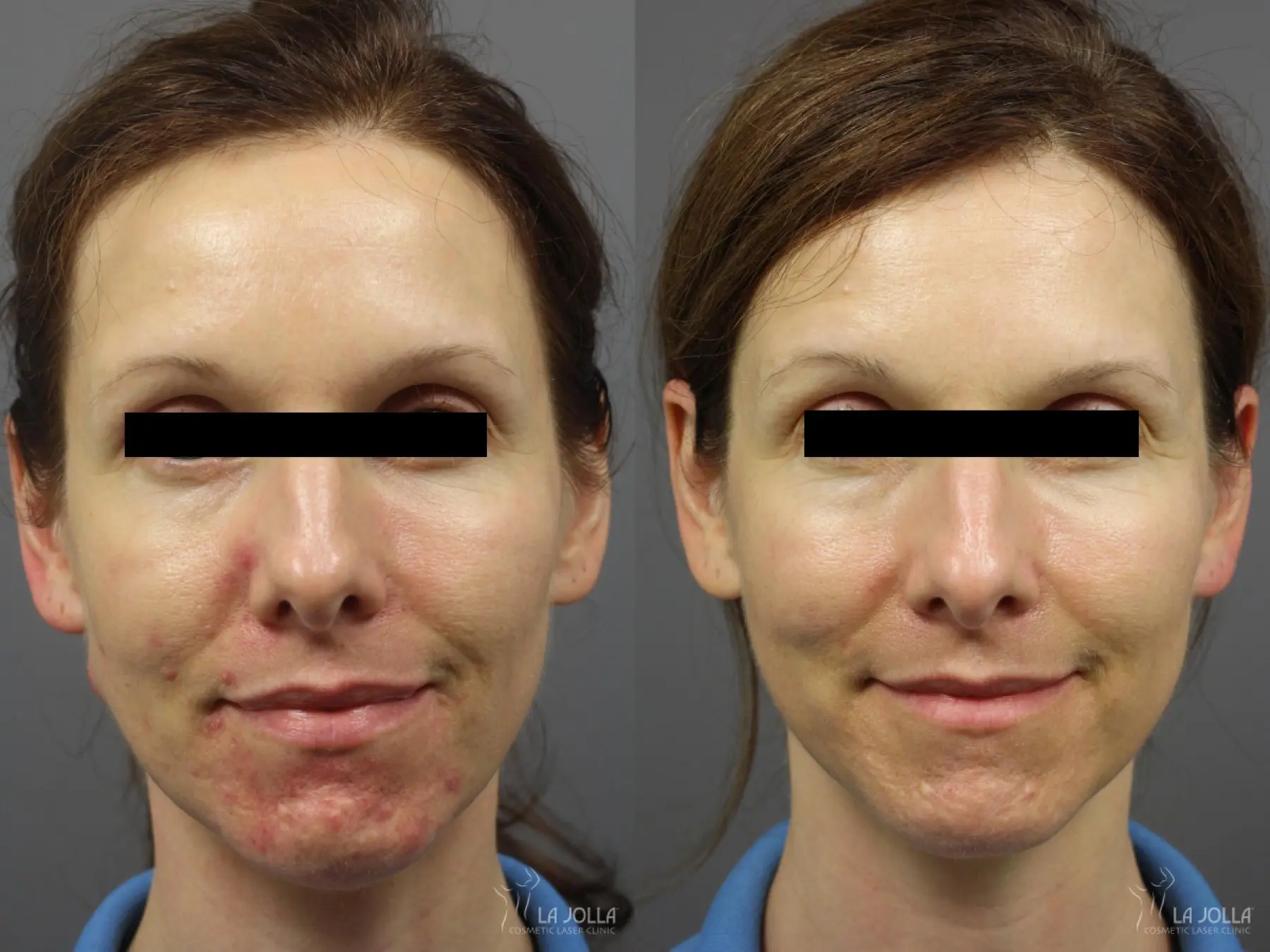 Acne: Laser Treatment: Patient 15 - Before and After 1