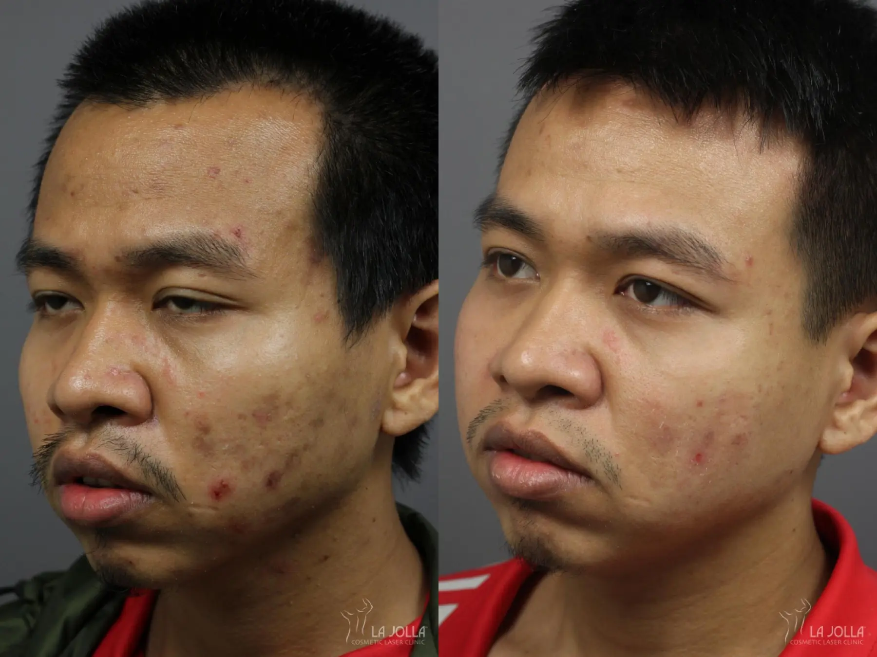 Acne: Laser Treatment: Patient 3 - Before and After 4
