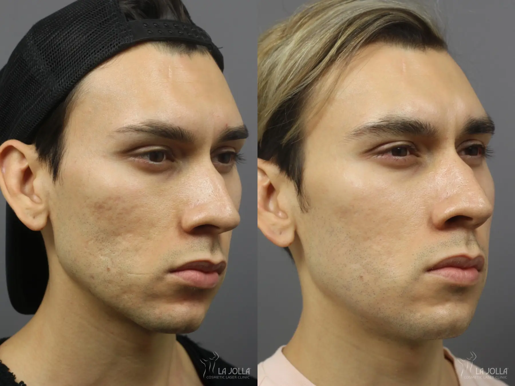 Acne: Laser Treatment: Patient 8 - Before and After  
