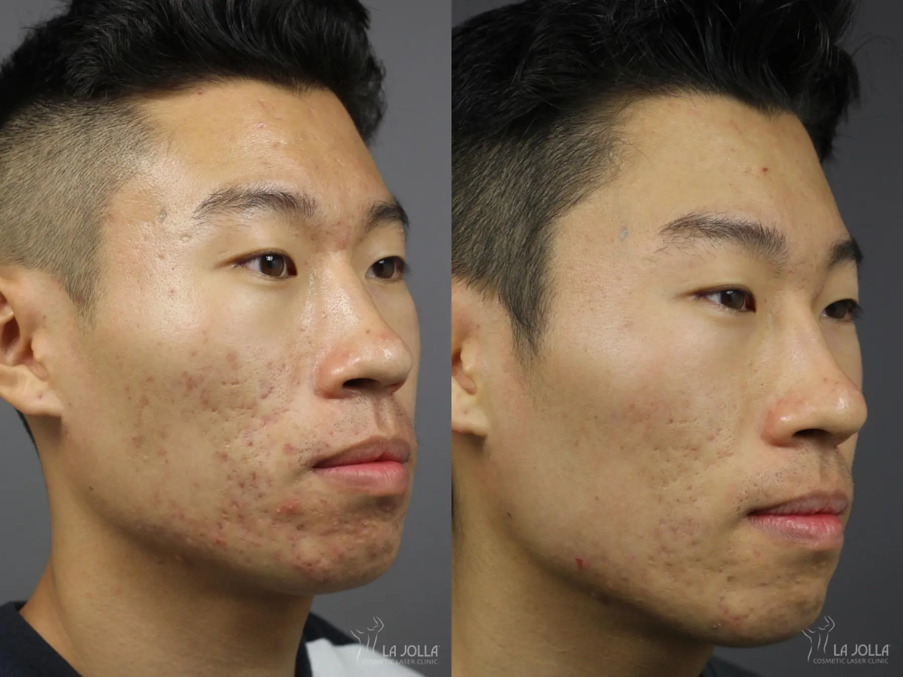 Acne: Laser Treatment: Patient 4 - Before and After 2