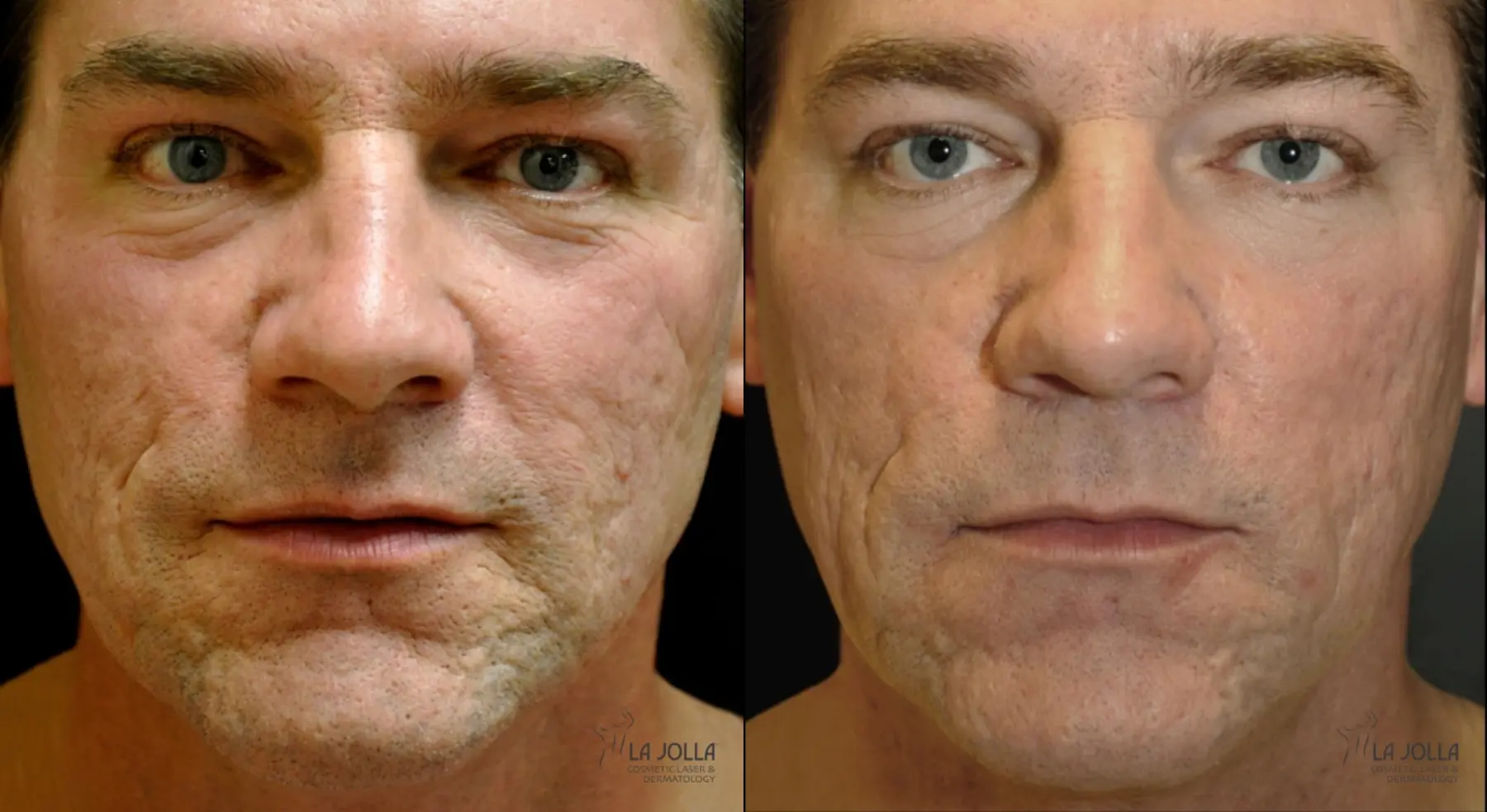 Acne: Laser Treatment: Patient 16 - Before and After 1
