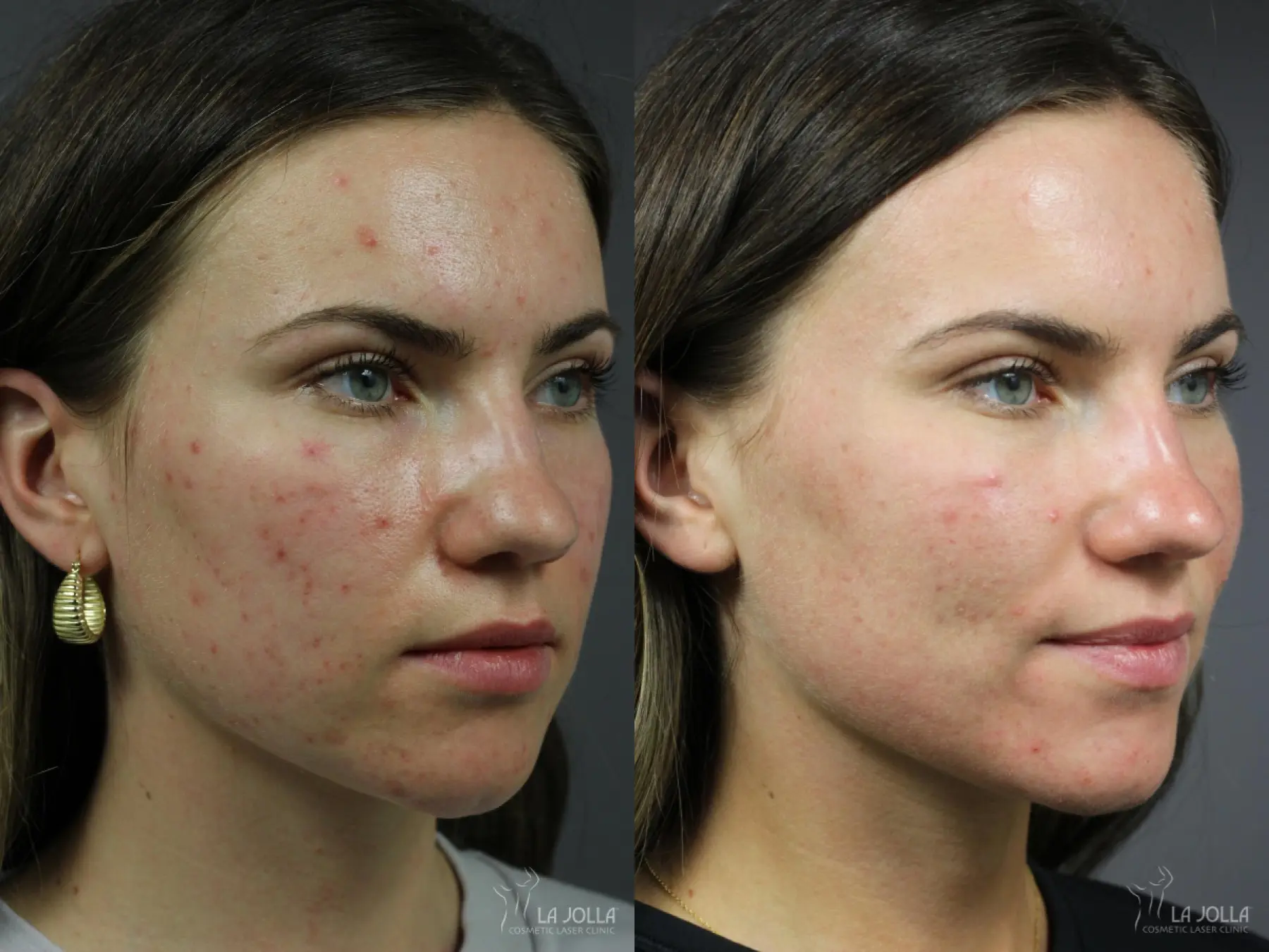 Acne: Laser Treatment: Patient 6 - Before and After 2