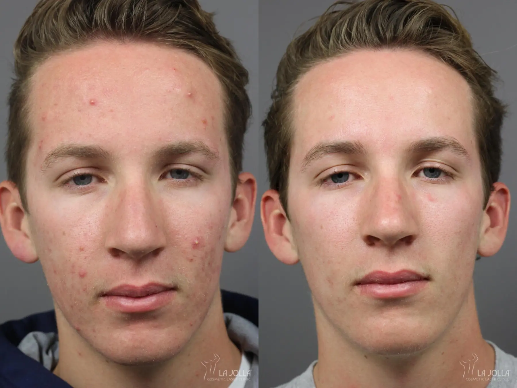 Acne: Laser Treatment: Patient 2 - Before and After  