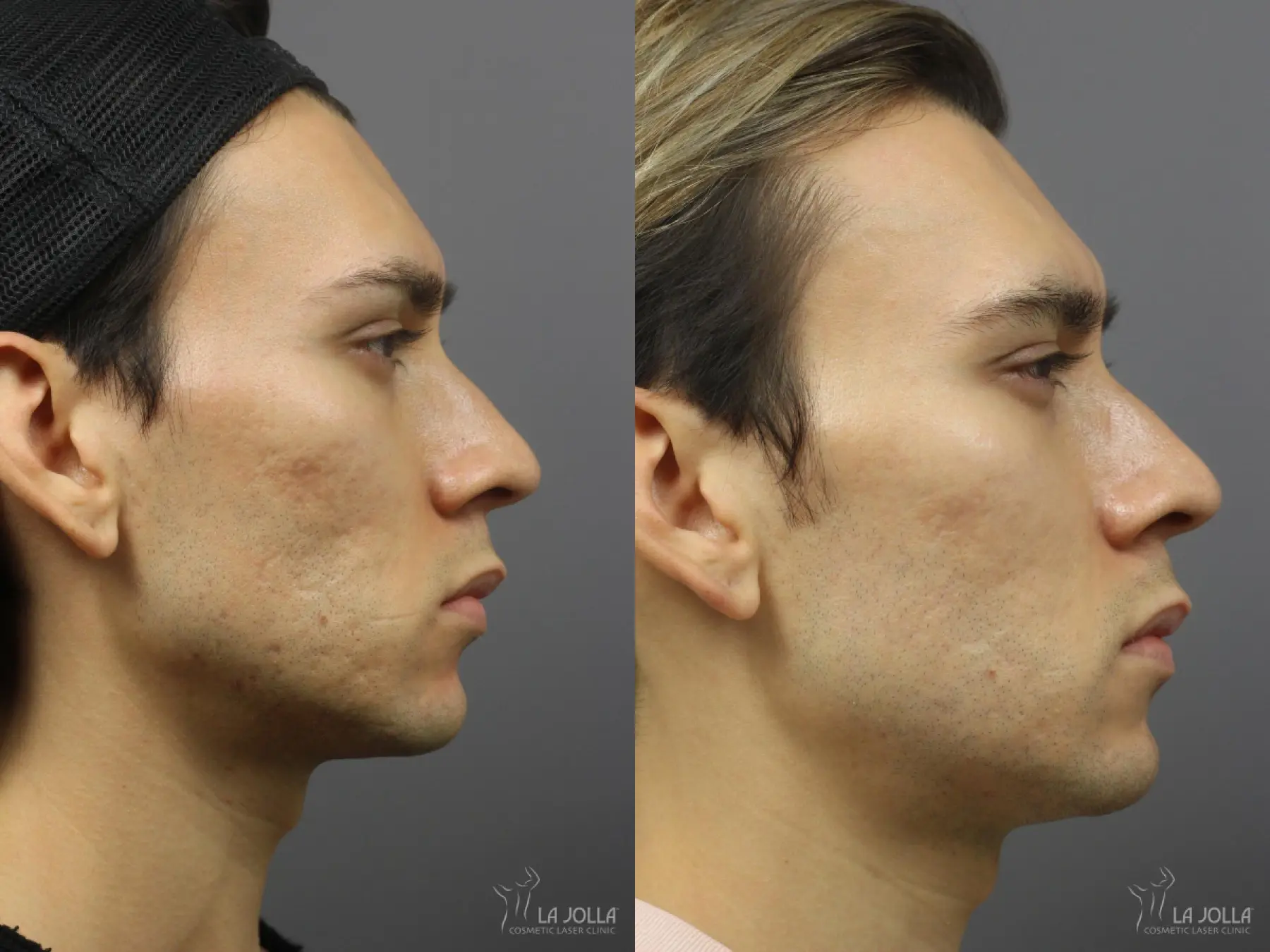 Acne: Laser Treatment: Patient 8 - Before and After 2