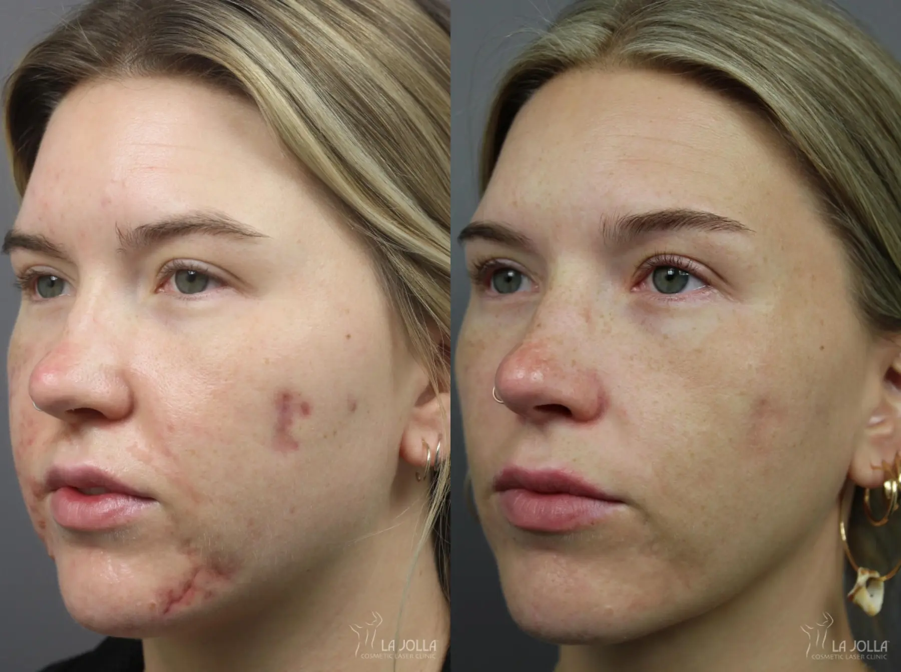 Acne: Laser Treatment: Patient 1 - Before and After 3