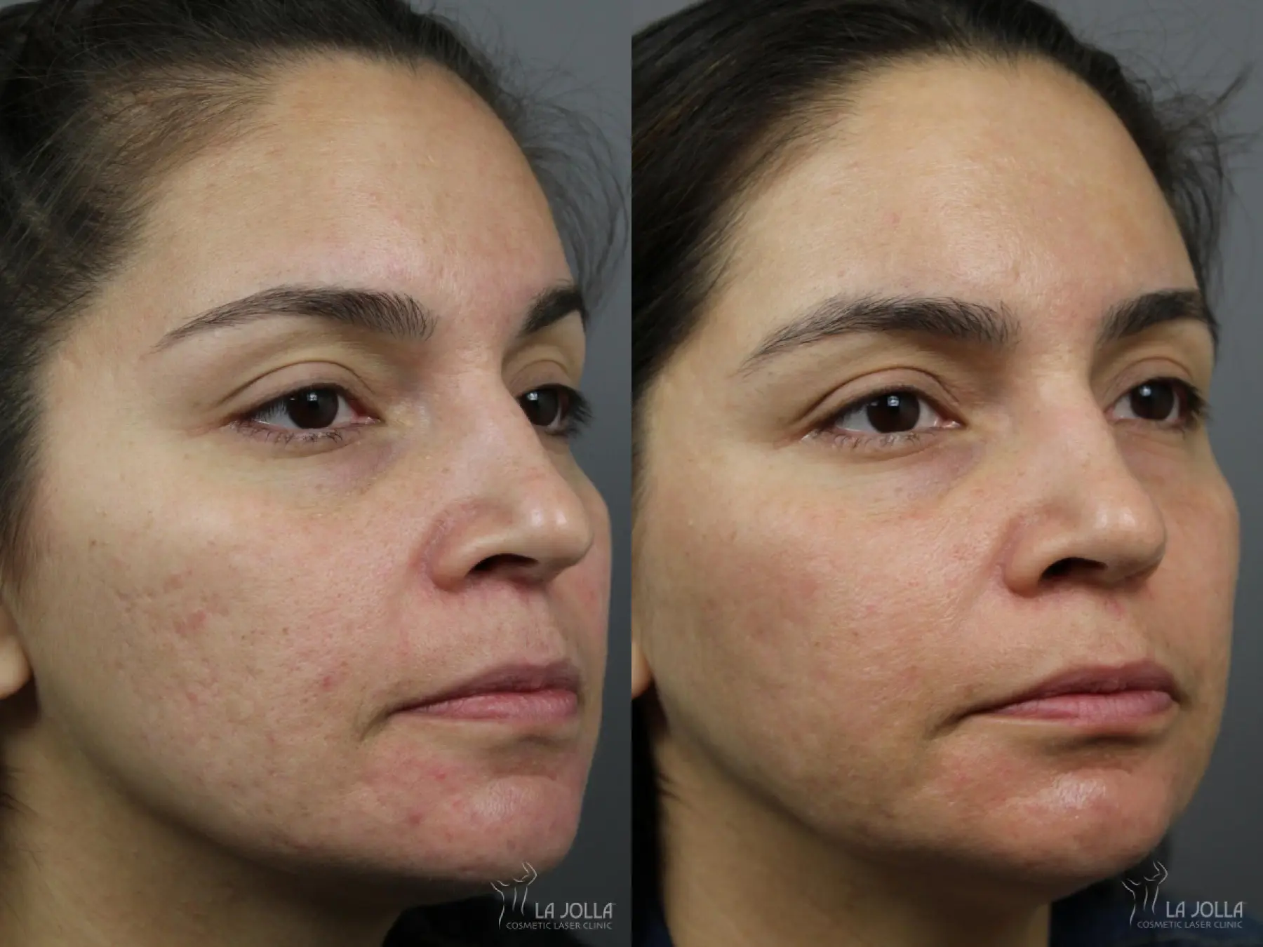 Acne: Laser Treatment: Patient 5 - Before and After 3