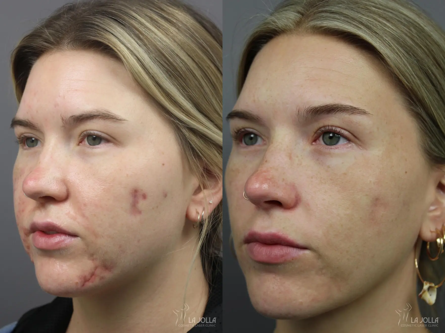 Acne: Laser Treatment: Patient 7 - Before and After 2