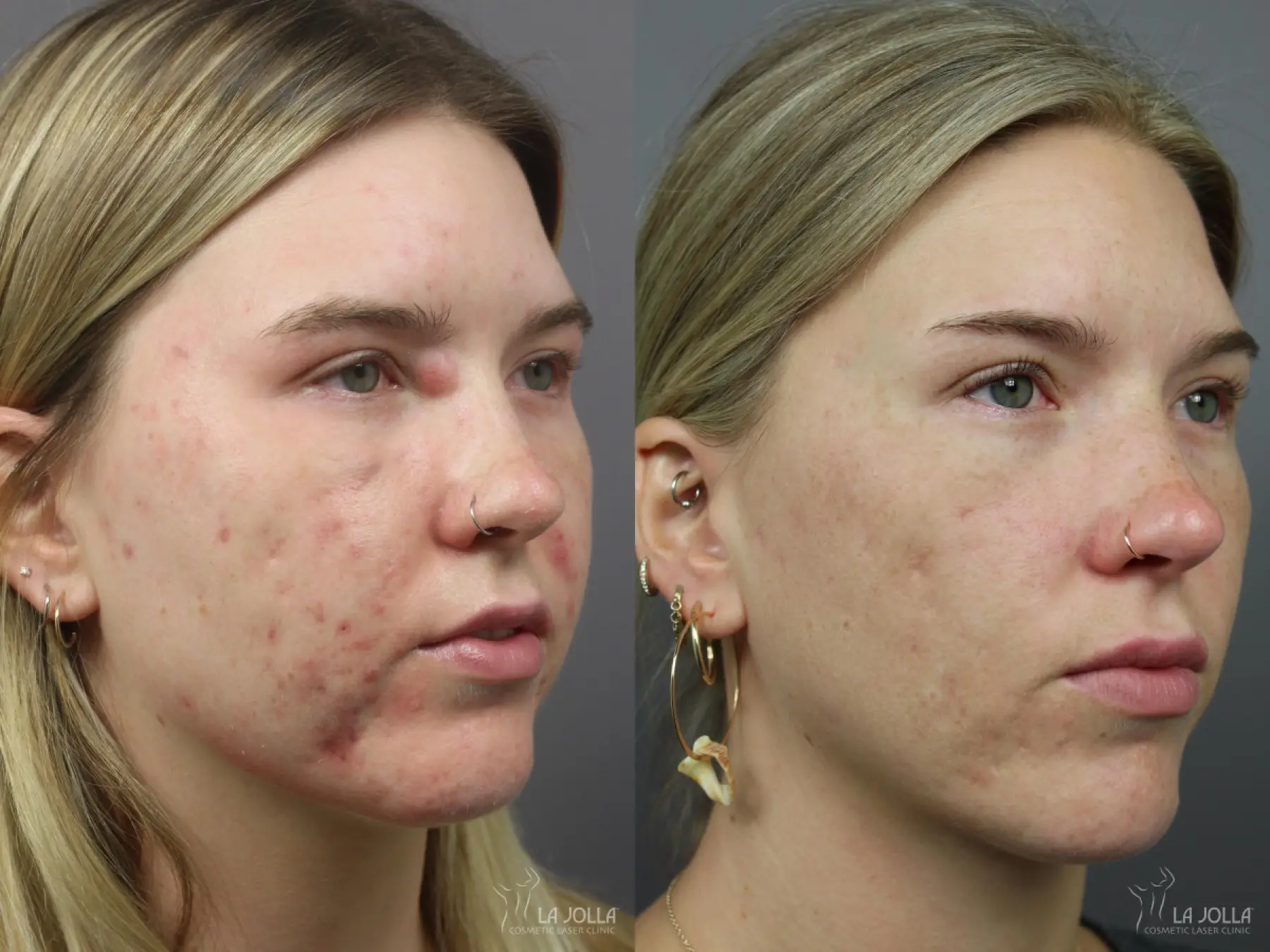 Acne: Laser Treatment: Patient 7 - Before and After  