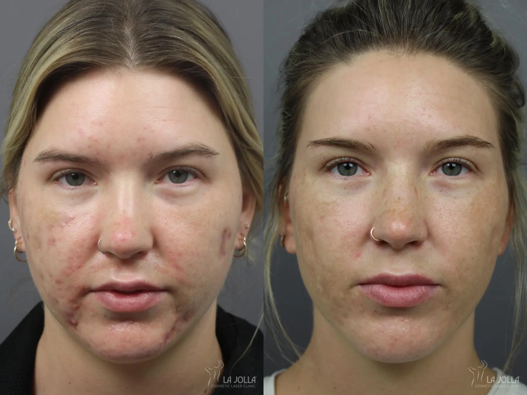 Acne: Laser Treatment: Patient 10 - Before and After  