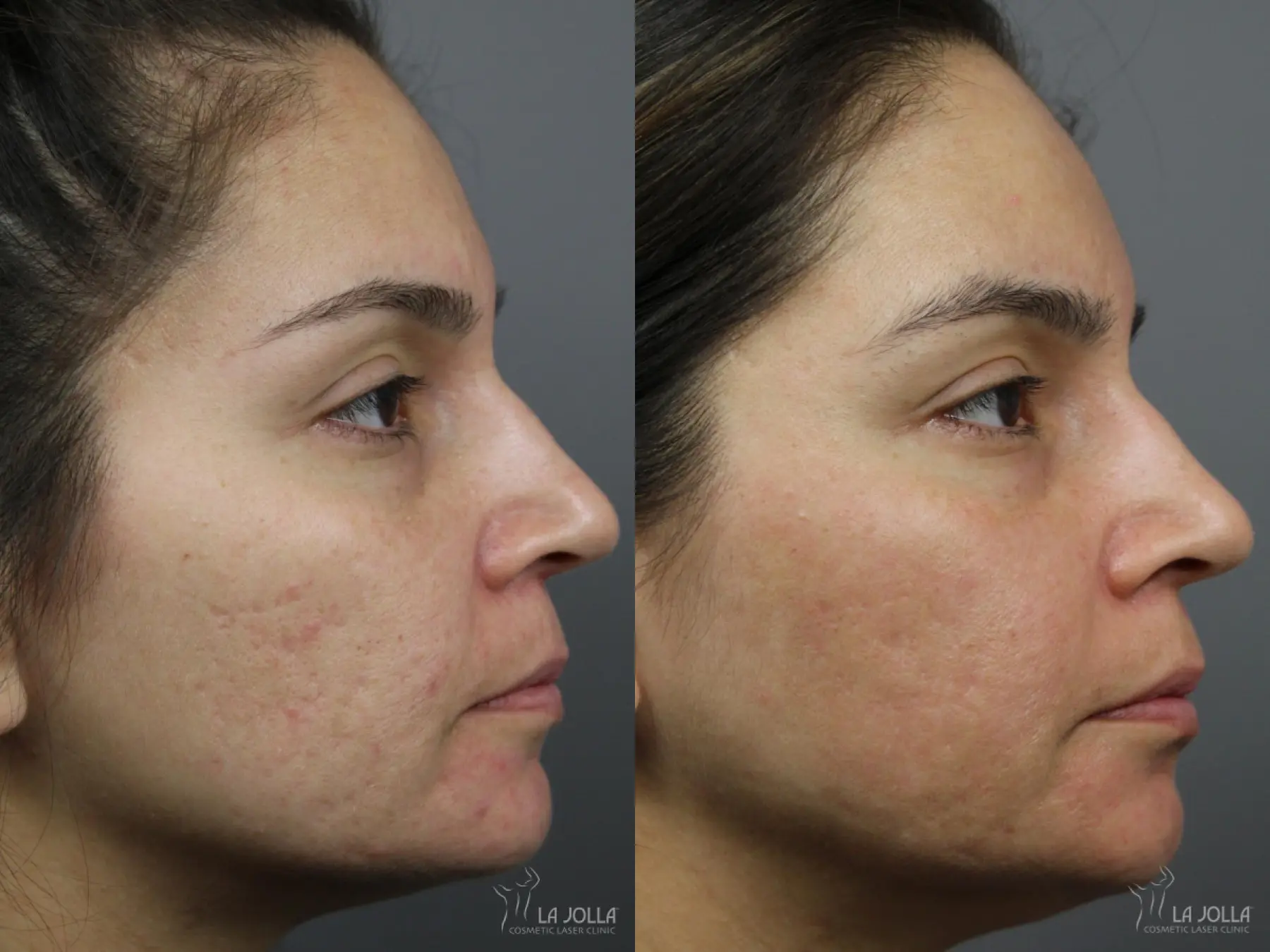 Acne: Laser Treatment: Patient 5 - Before and After  