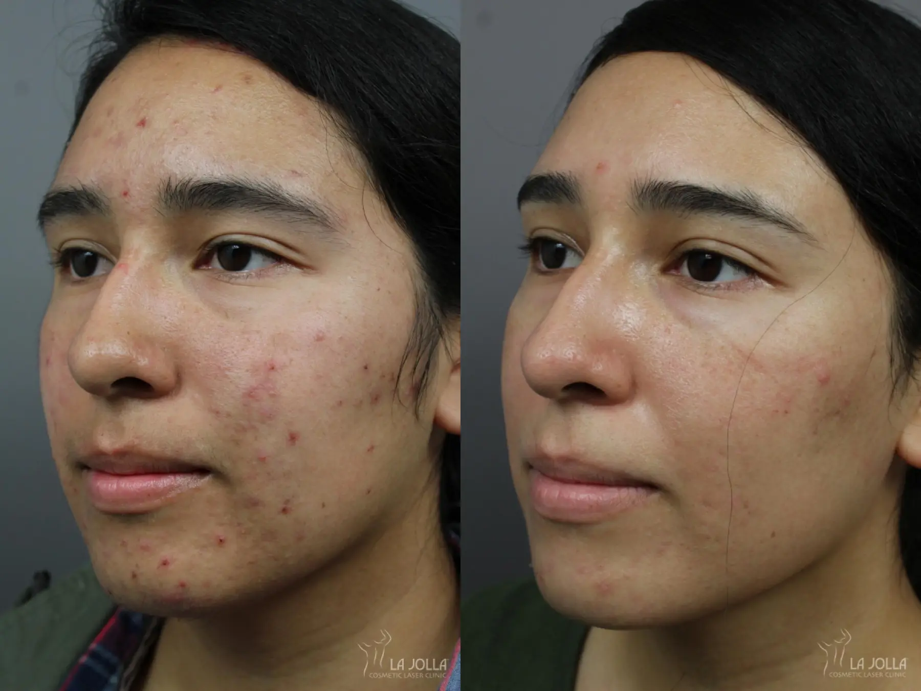 Acne: Laser Treatment: Patient 9 - Before and After 2